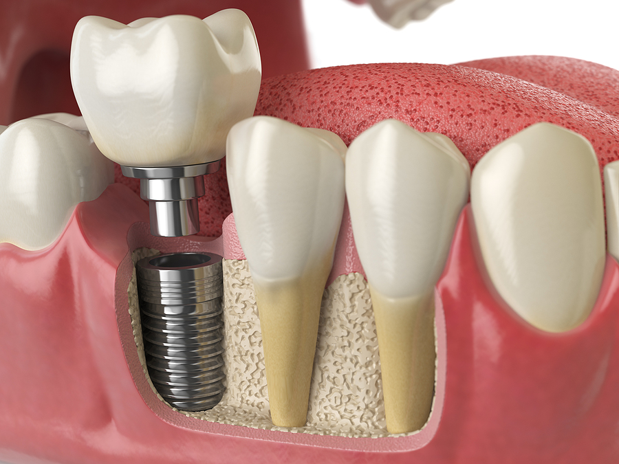 Everything You Need to Know About Dental Implants: A Permanent Solution for Missing Teeth
