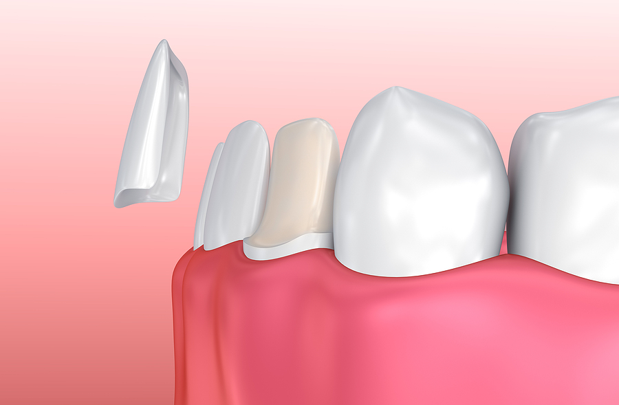 Enhance Your Smile with Porcelain Veneers: A Complete Guide