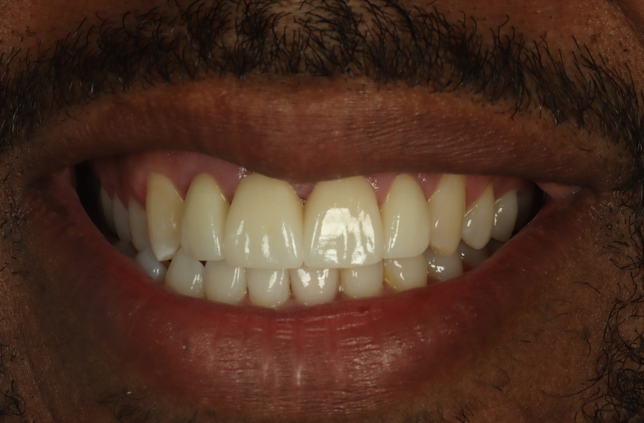 Anthony N after gummy smiles