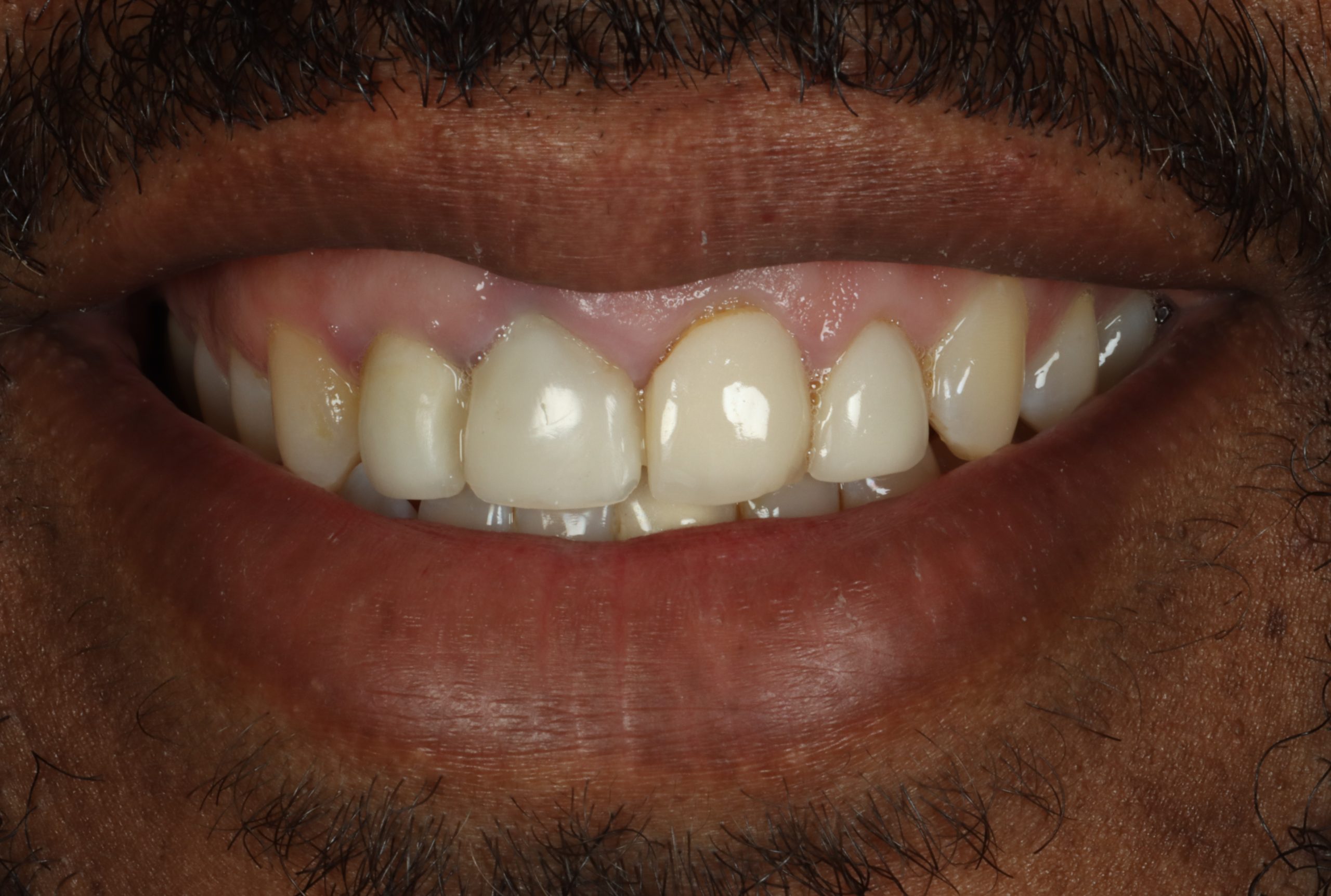 Anthony N before gummy smiles