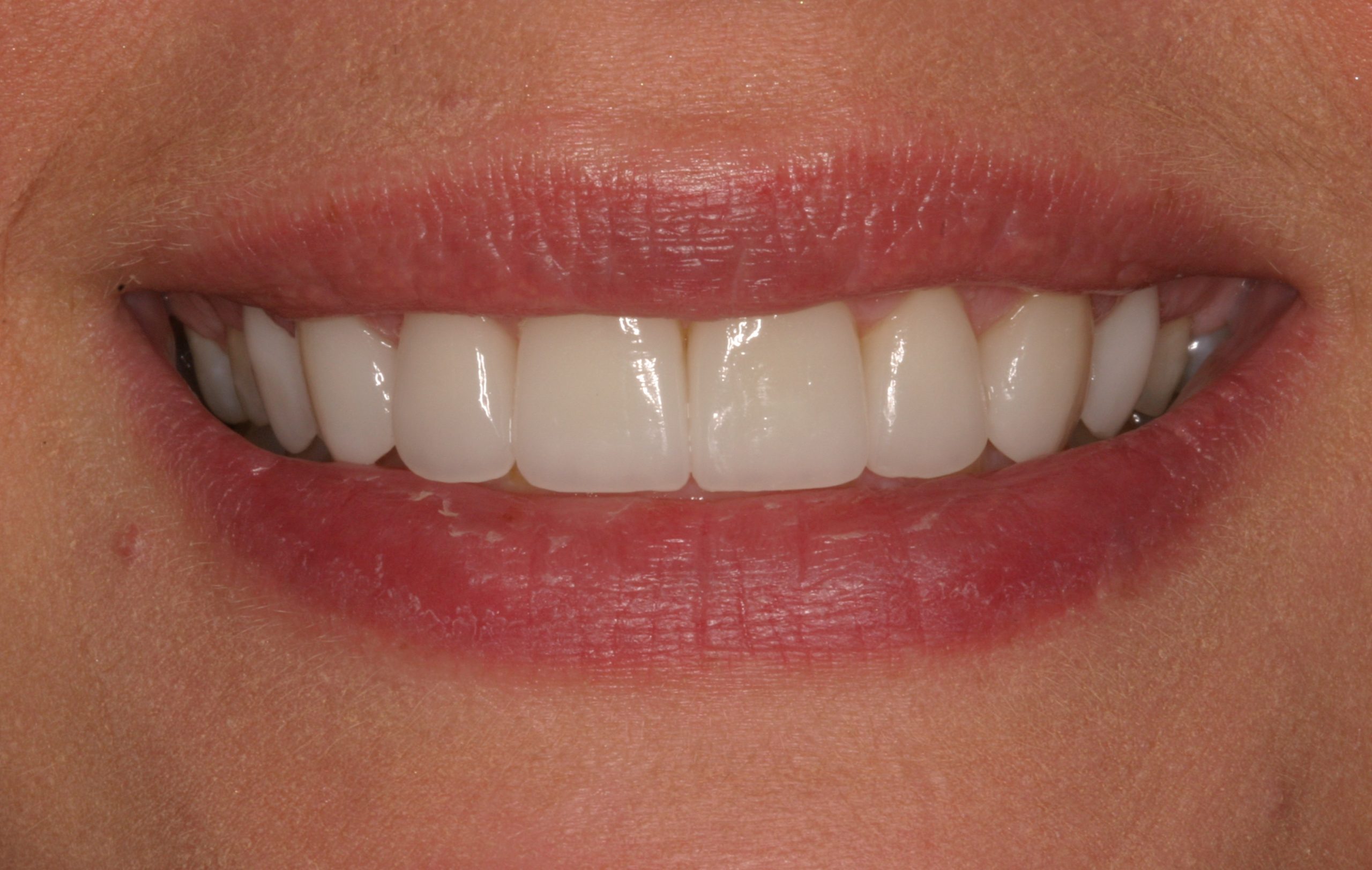 Aysha K after gummy smiles