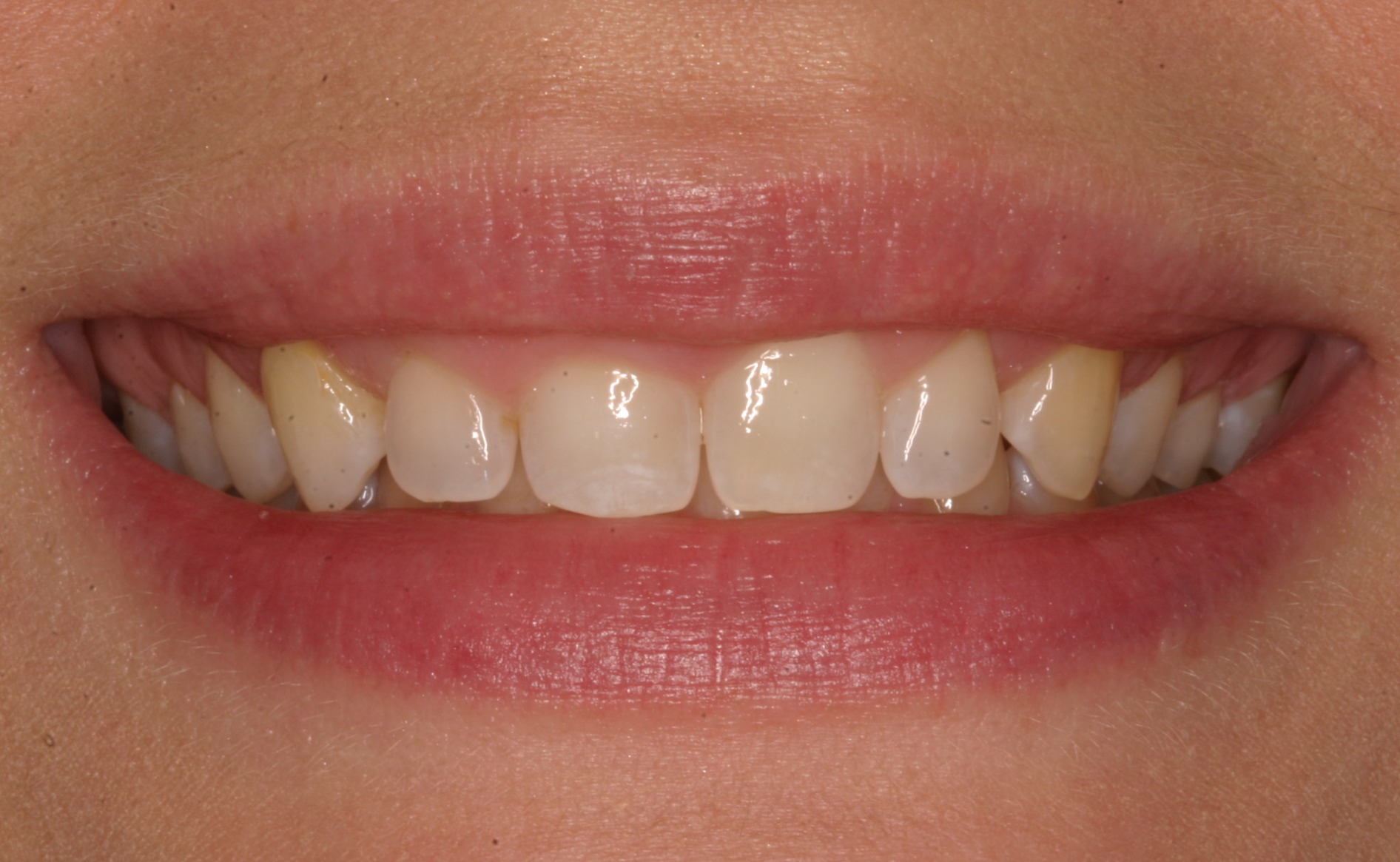 Aysha K before gummy smiles