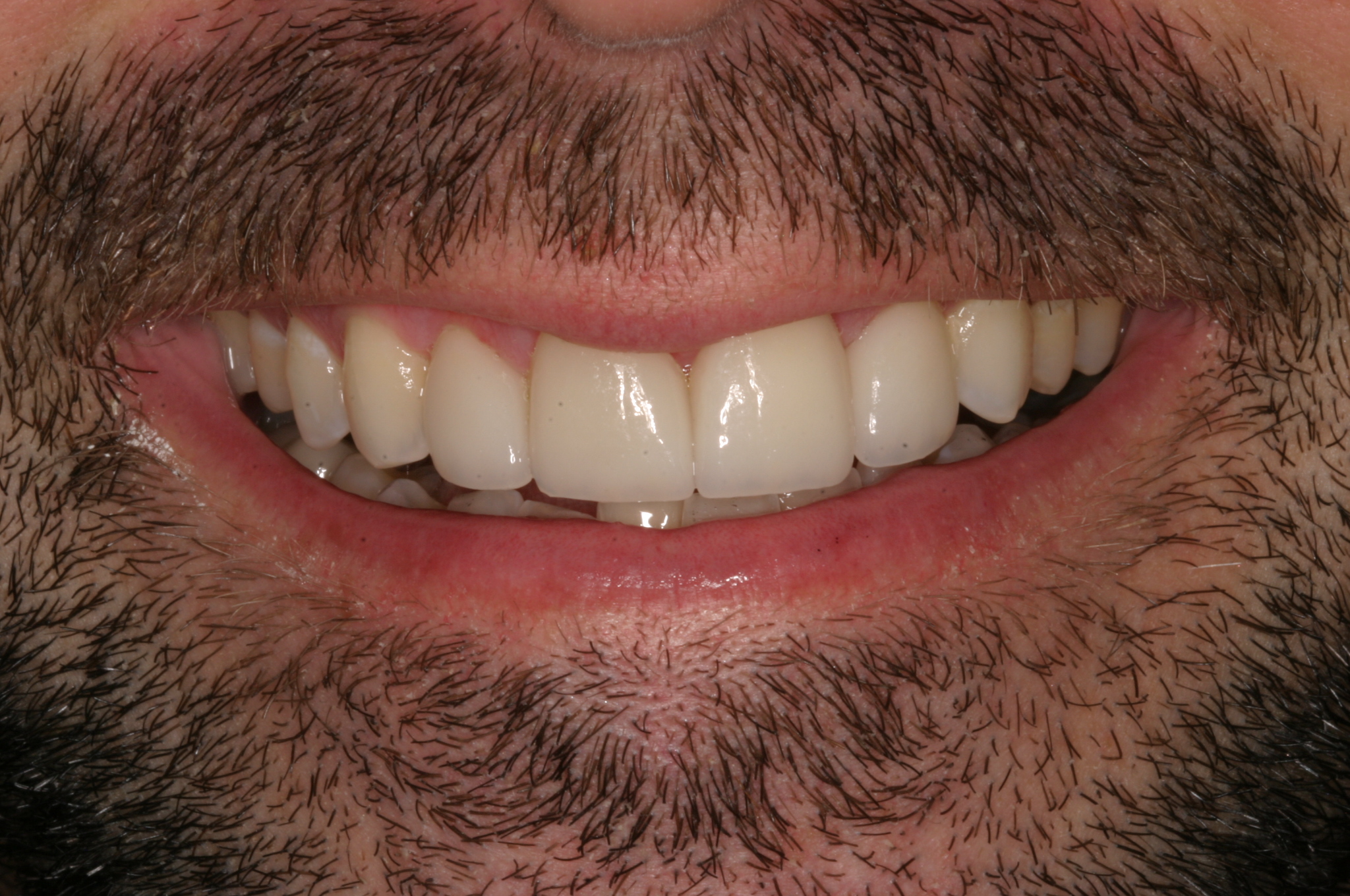 Bradley M after gummy smiles