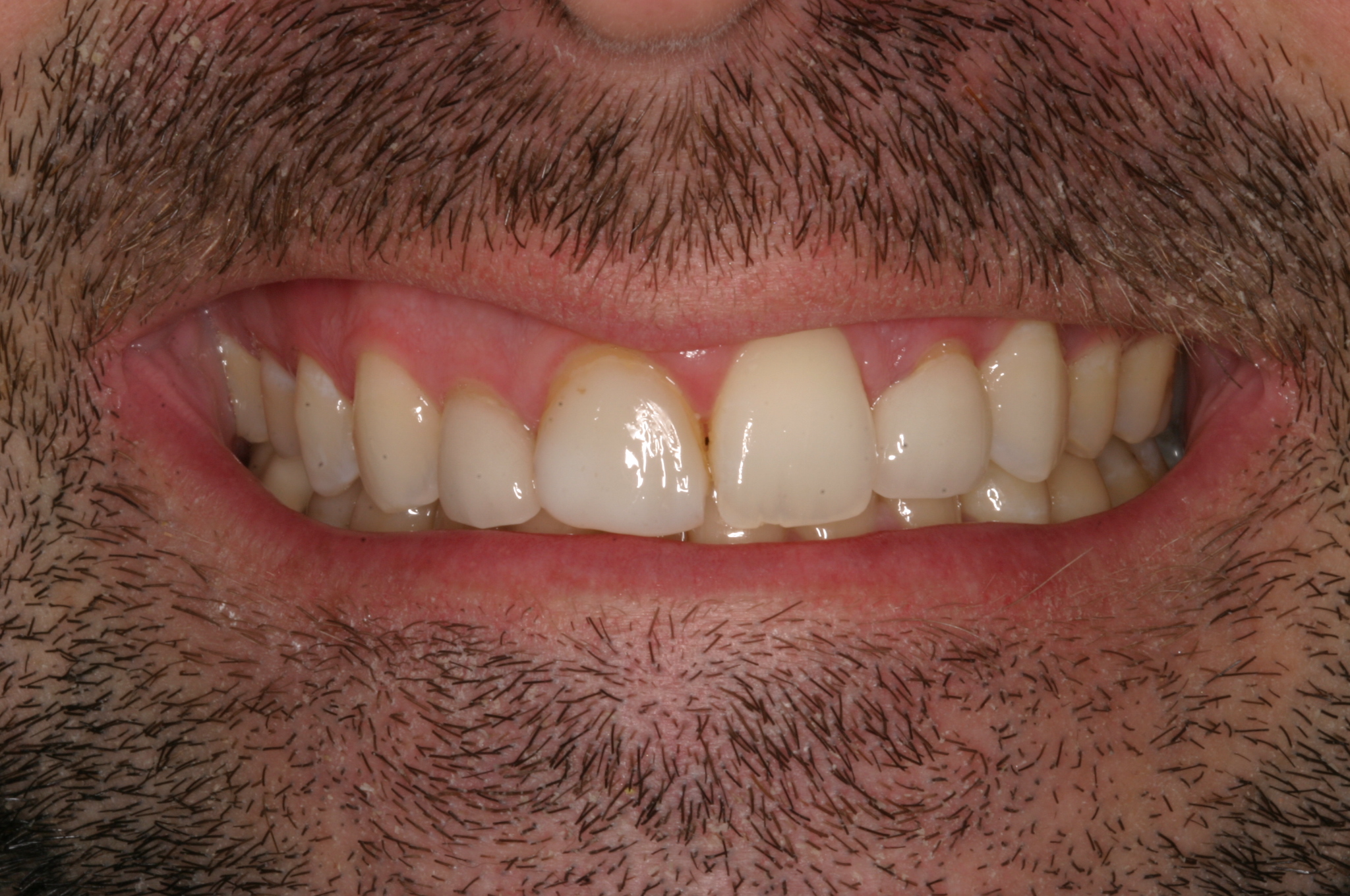 Bradley M before gummy smiles