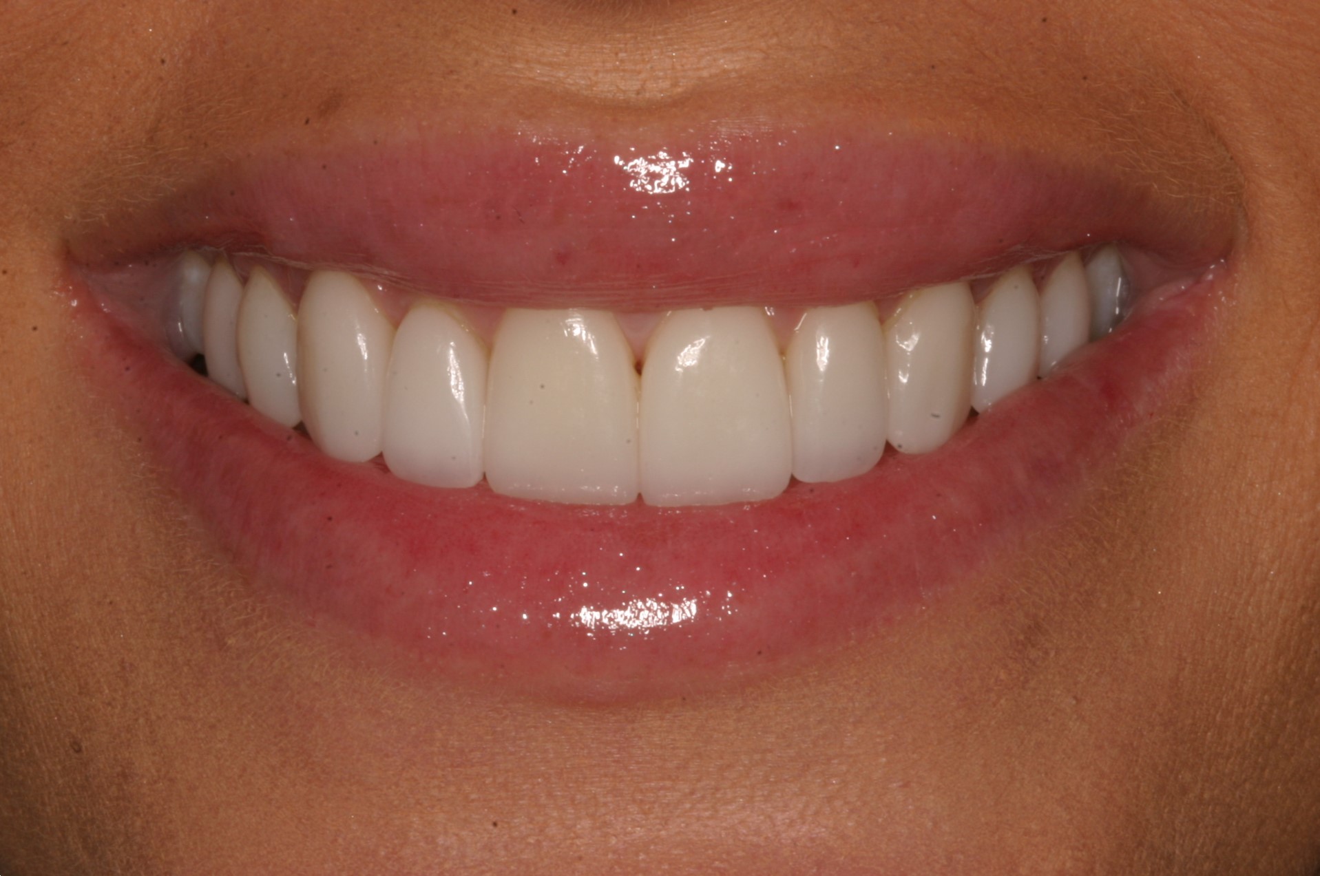 Cassie after dental veneers