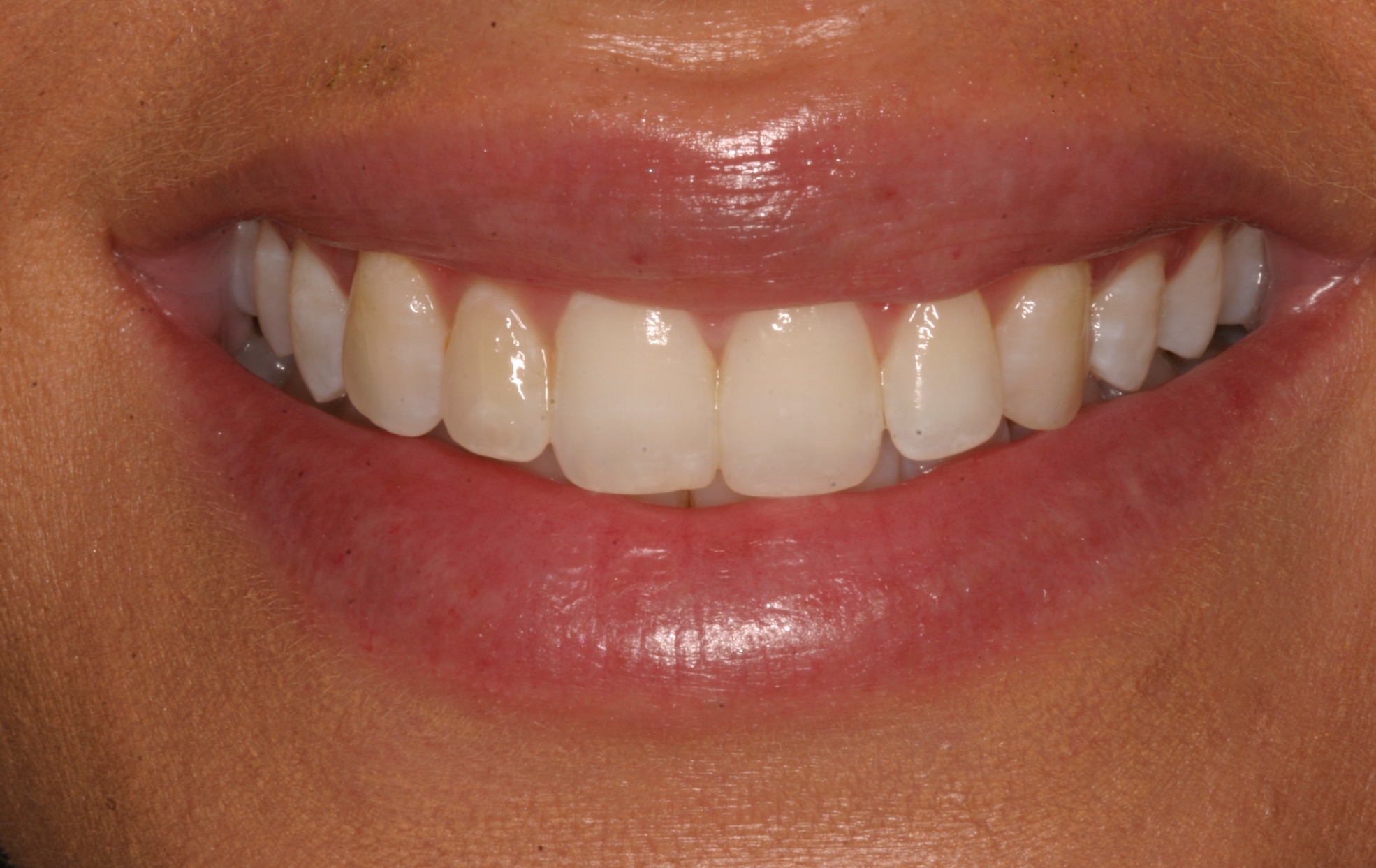 Cassie before dental veneers