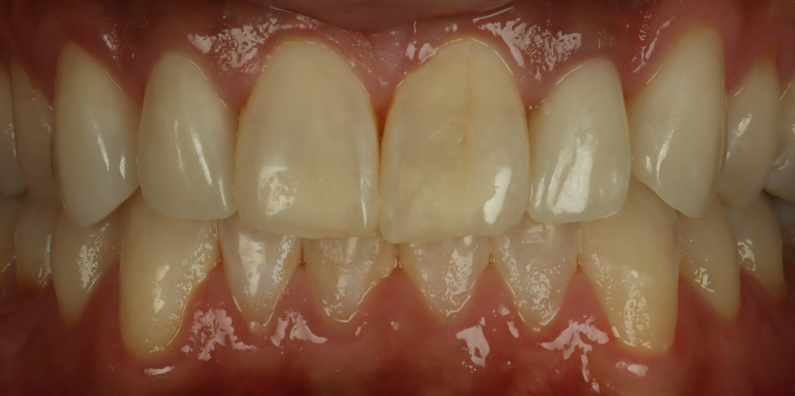 Chris S after dental veneers