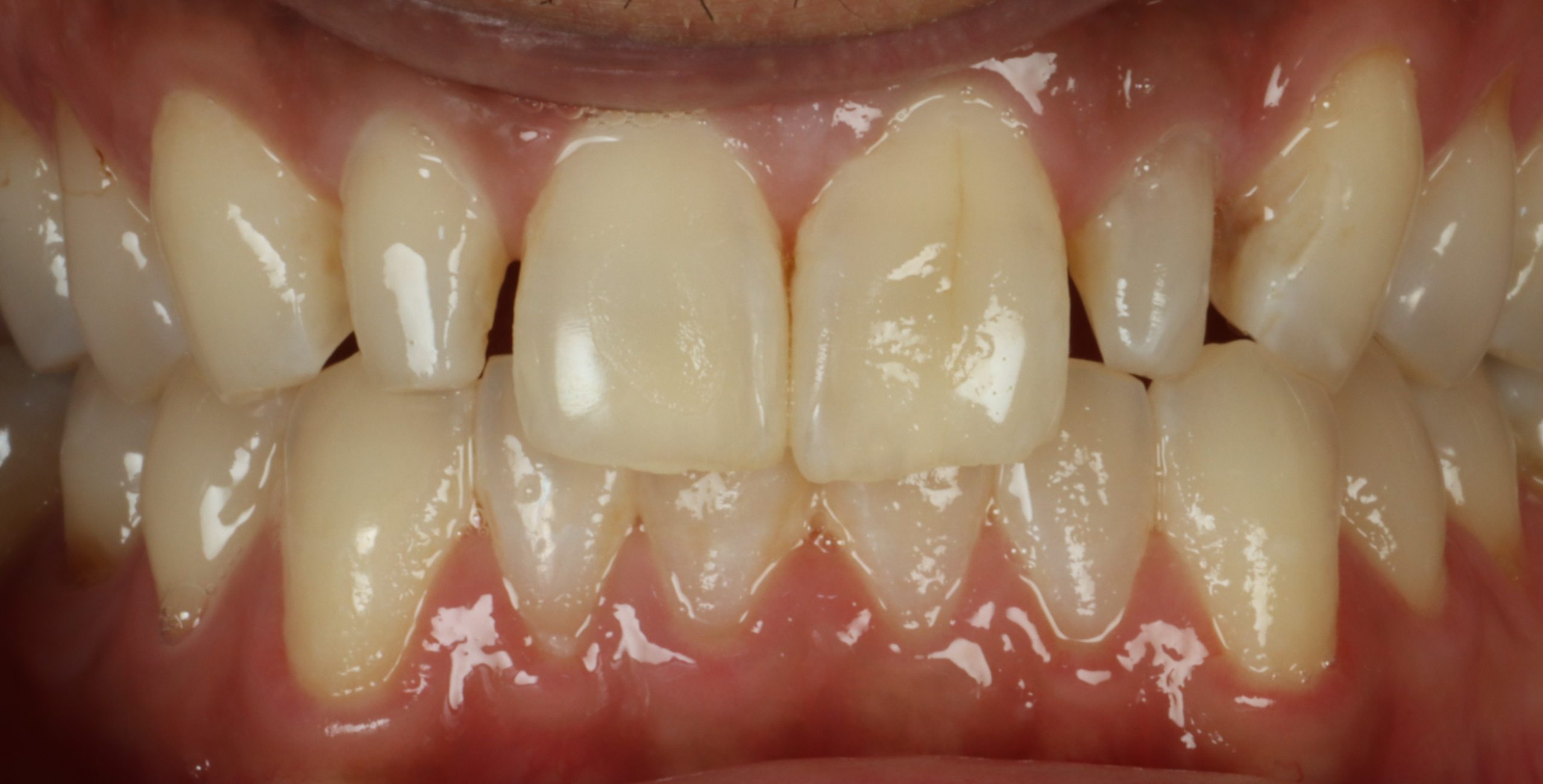 Chris S before dental veneers