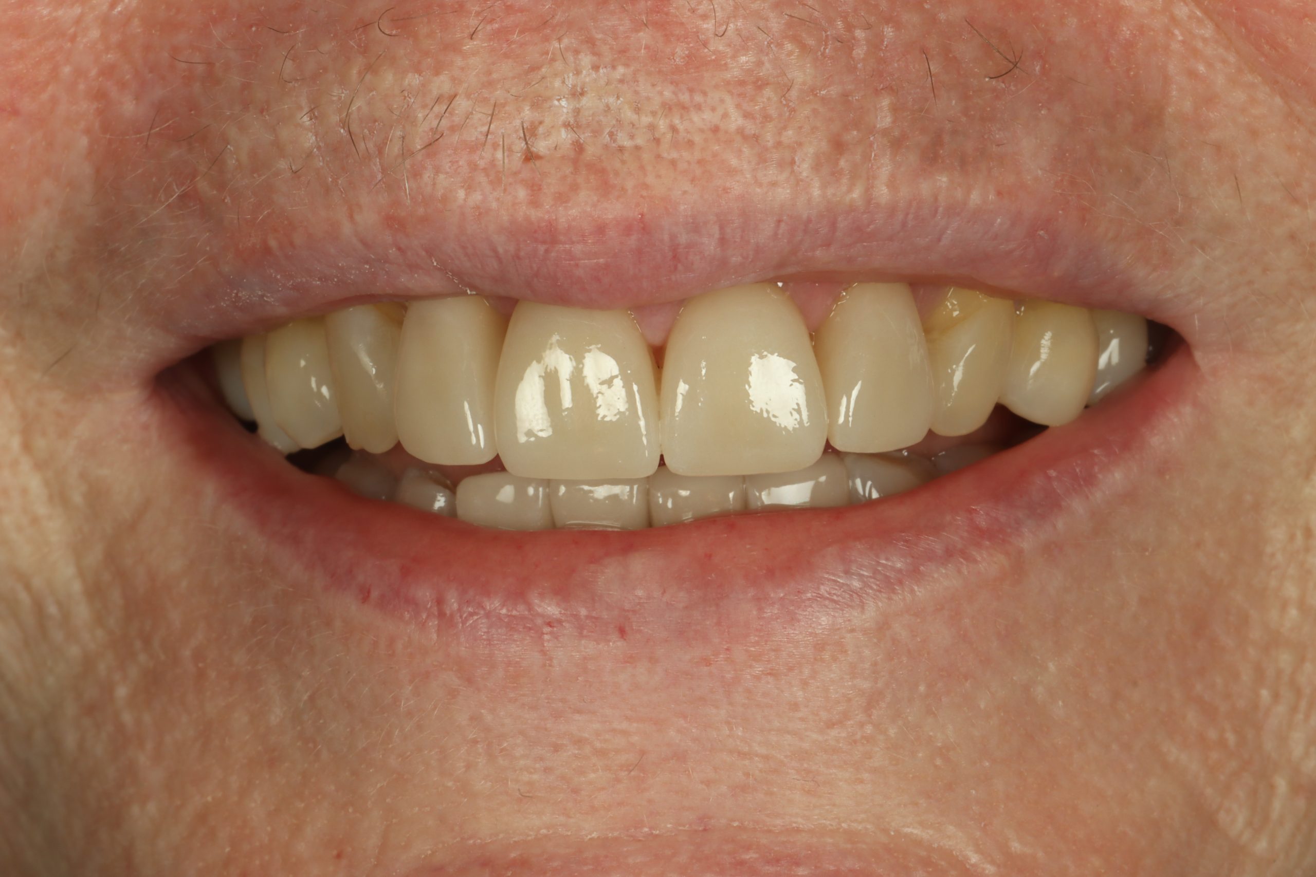 Christine K after dental veneers
