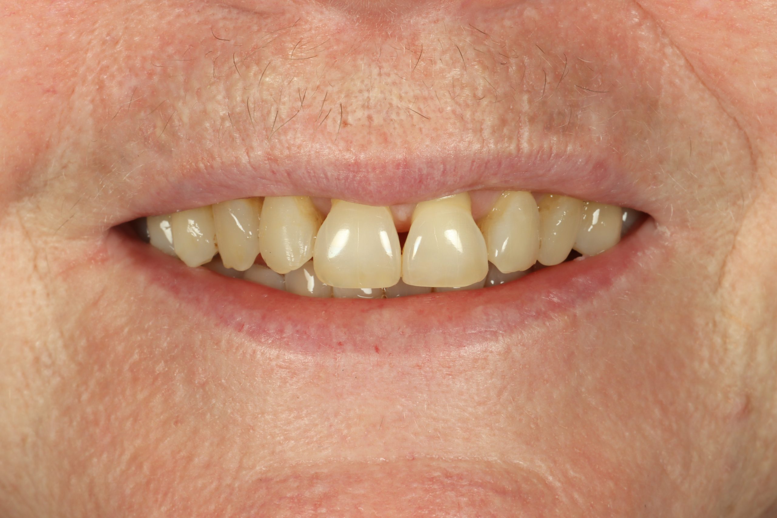 Christine K before dental veneers