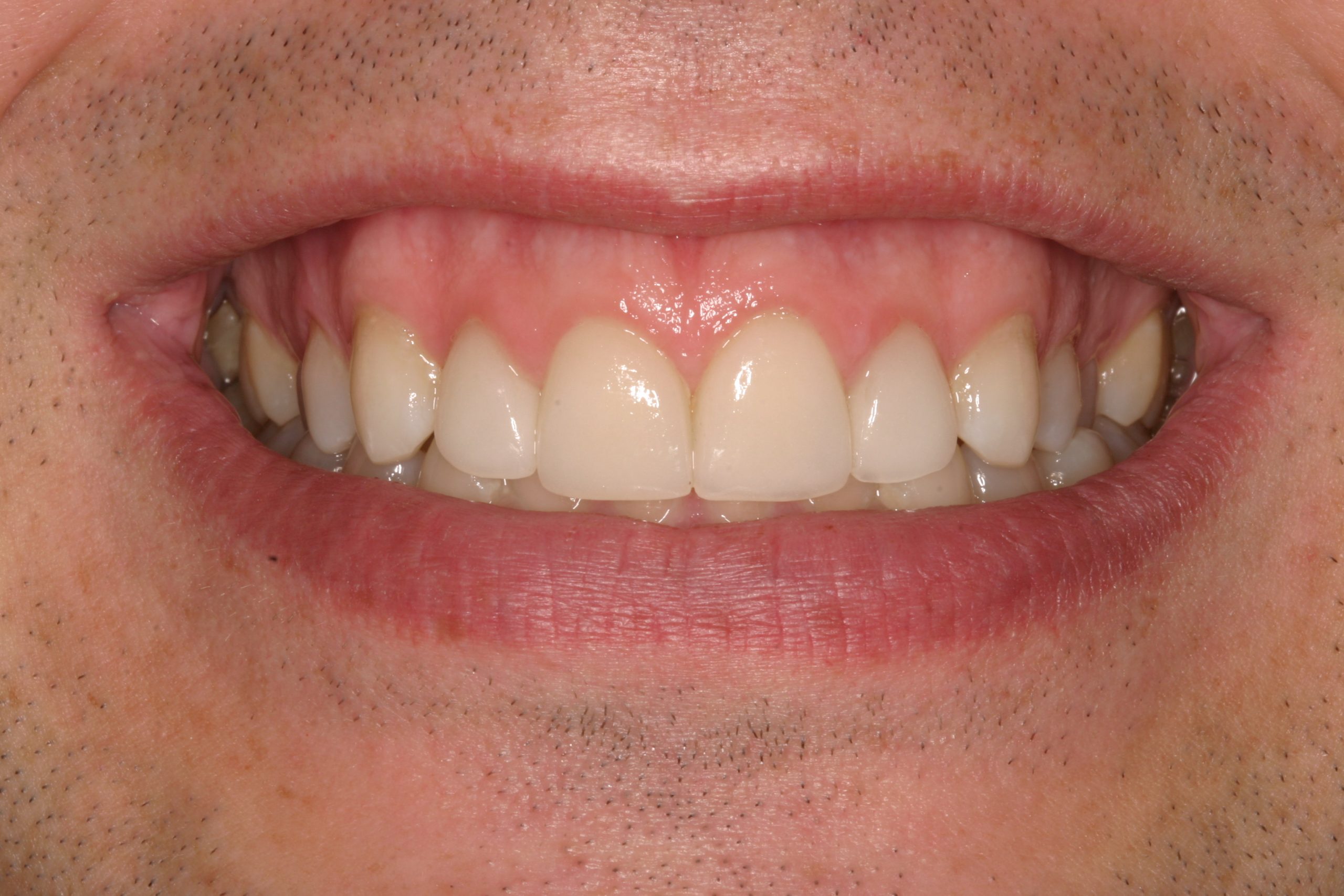 Christopher O after discolored teeth