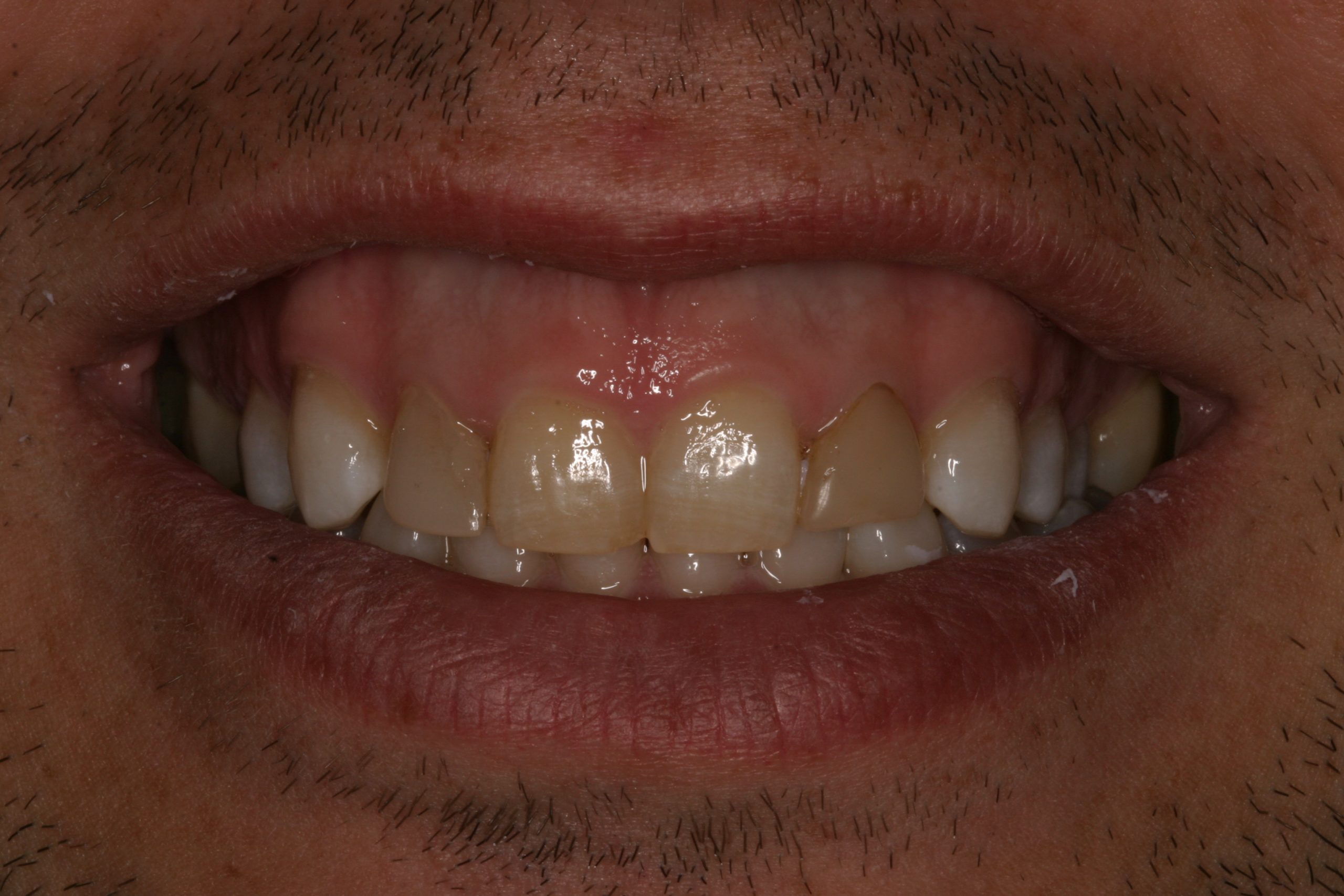 Christopher O before discolored teeth