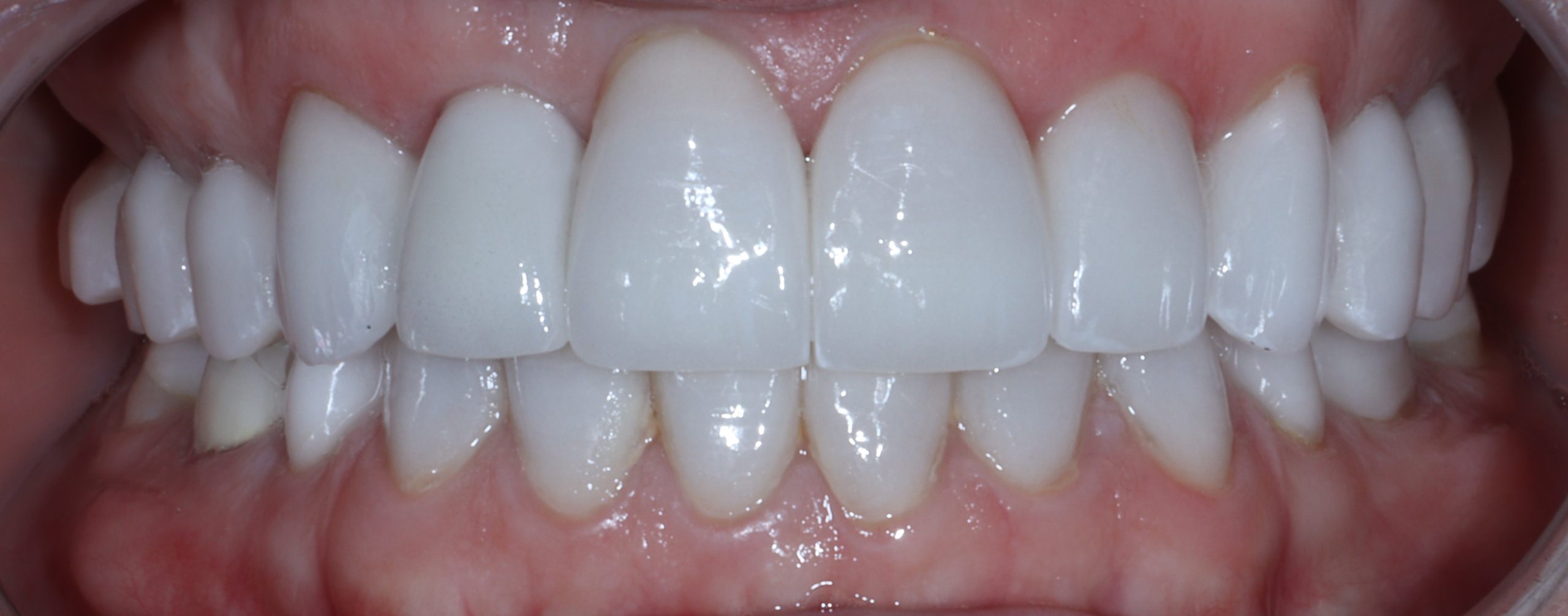 Cindy after smile rejuvenation