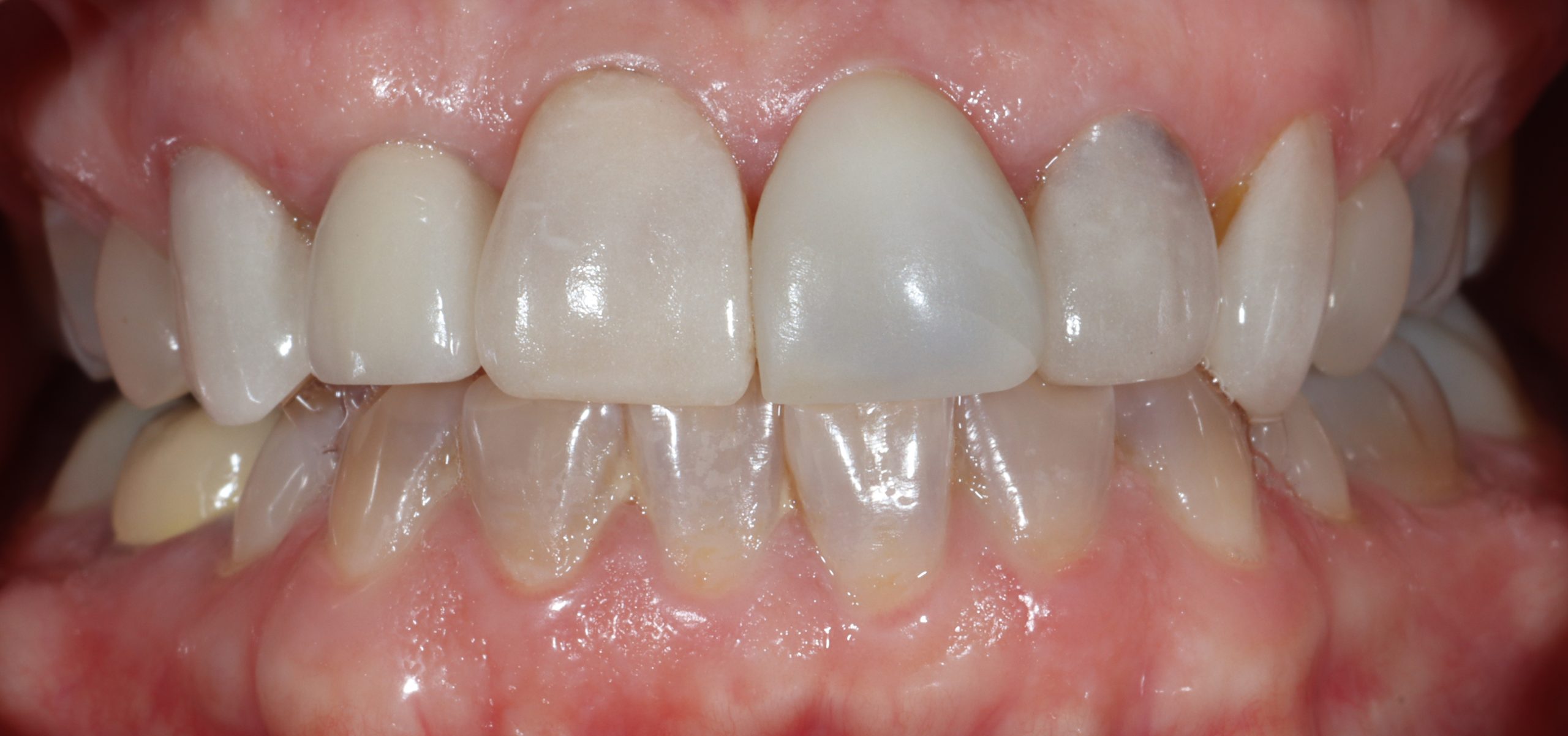 Cindy before smile rejuvenation