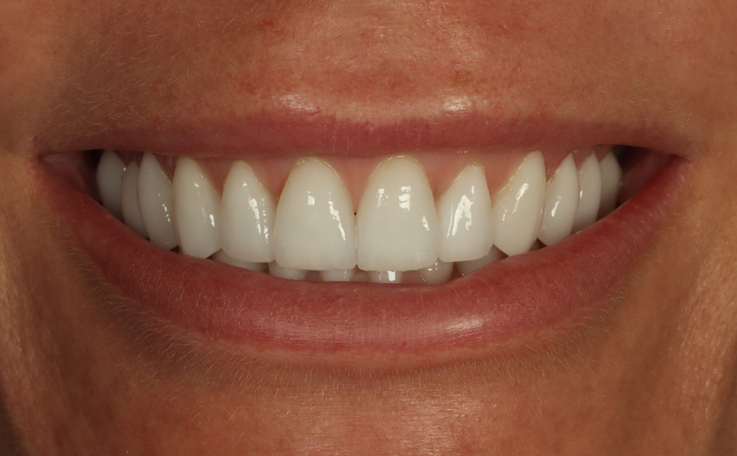 Crystal F after worn teeth