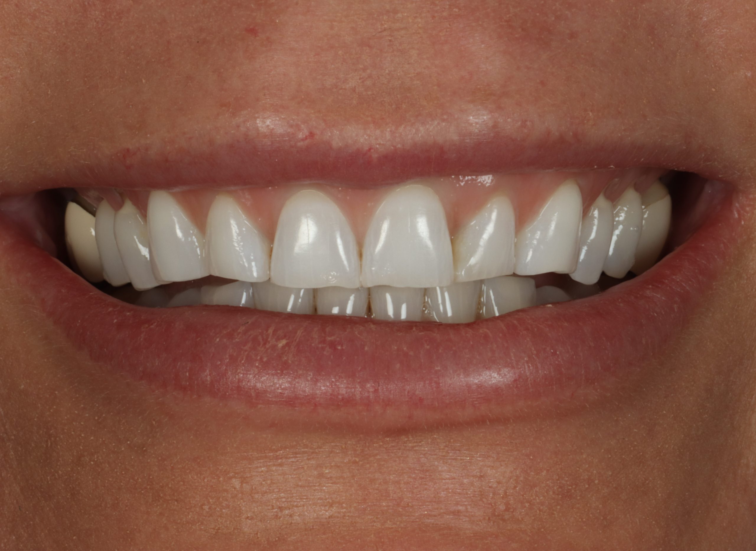 Crystal F before worn teeth