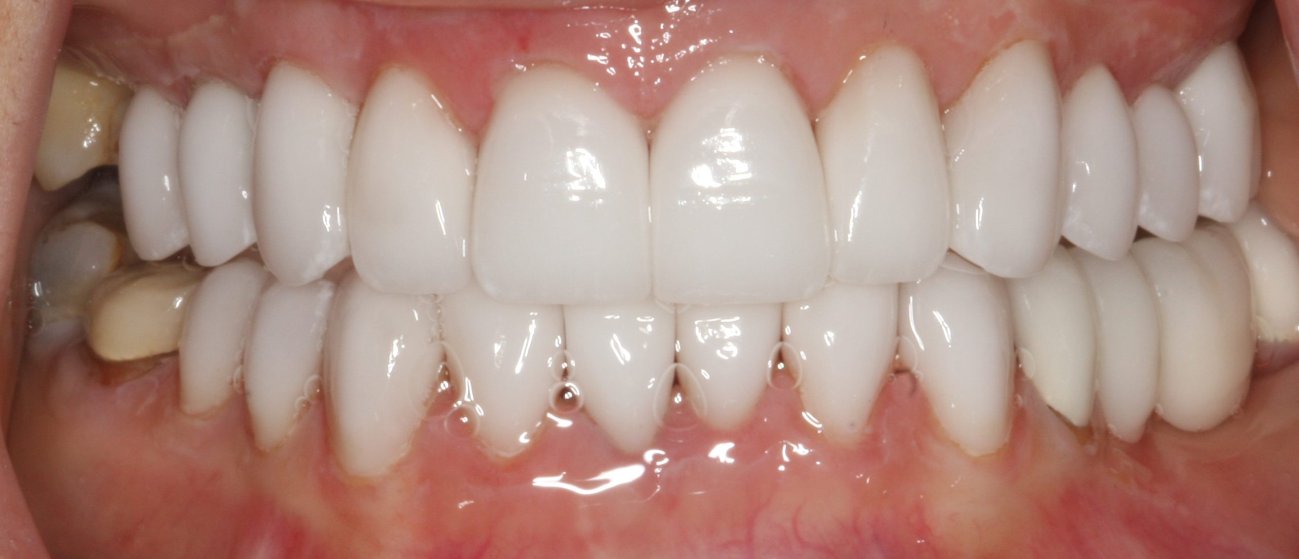 Deejee after worn teeth
