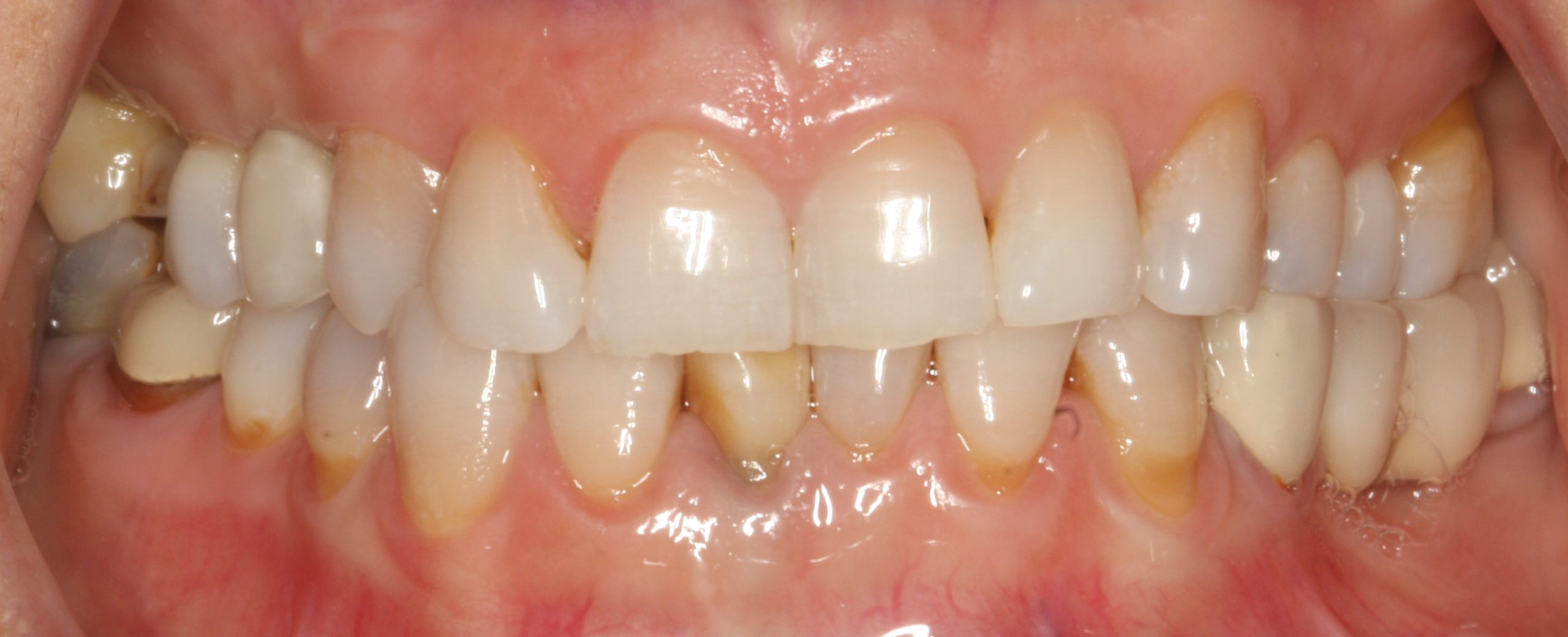Deejee before worn teeth