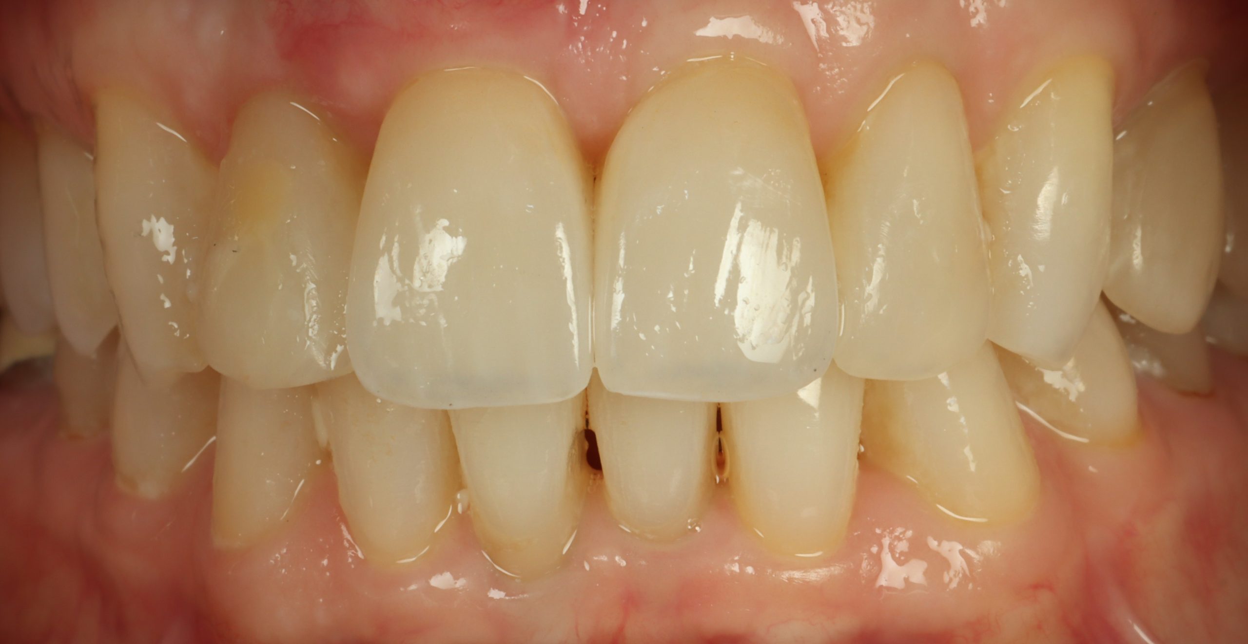 Diane L after dental veneers