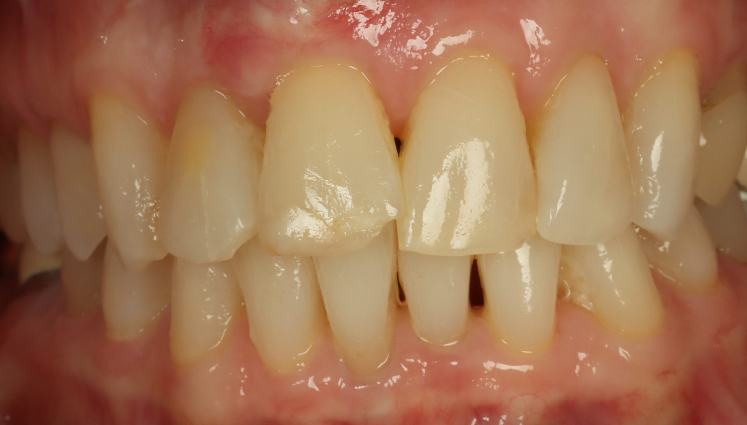 Diane L before dental veneers