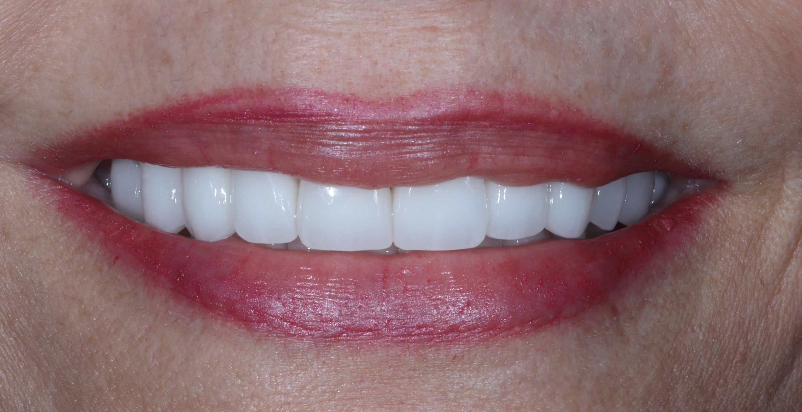Donna J after worn teeth