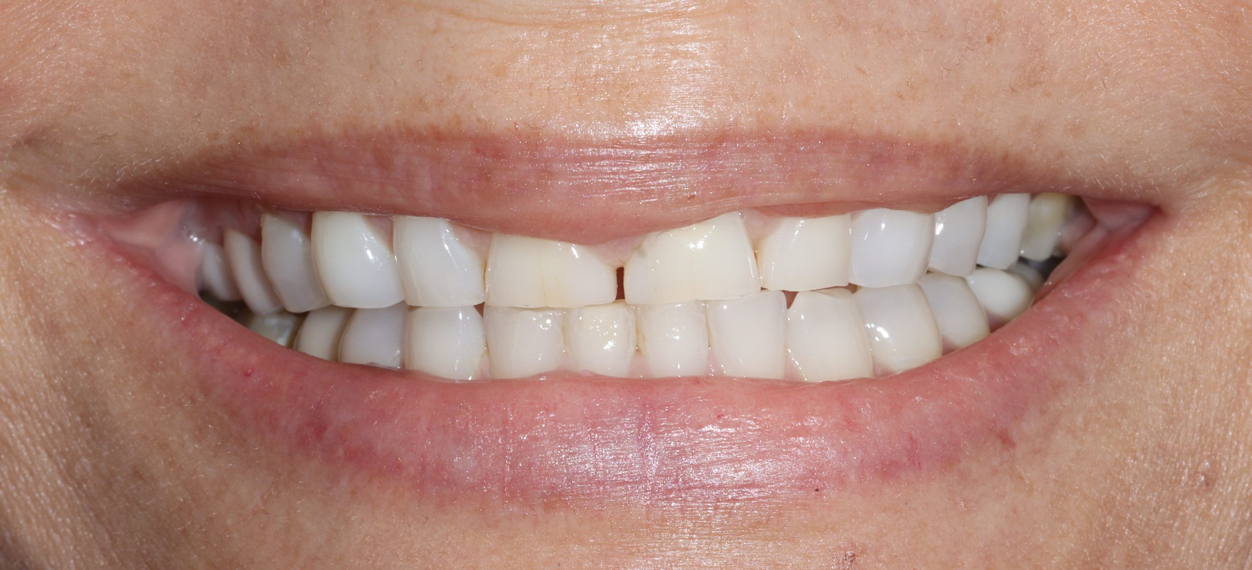 Donna J before worn teeth