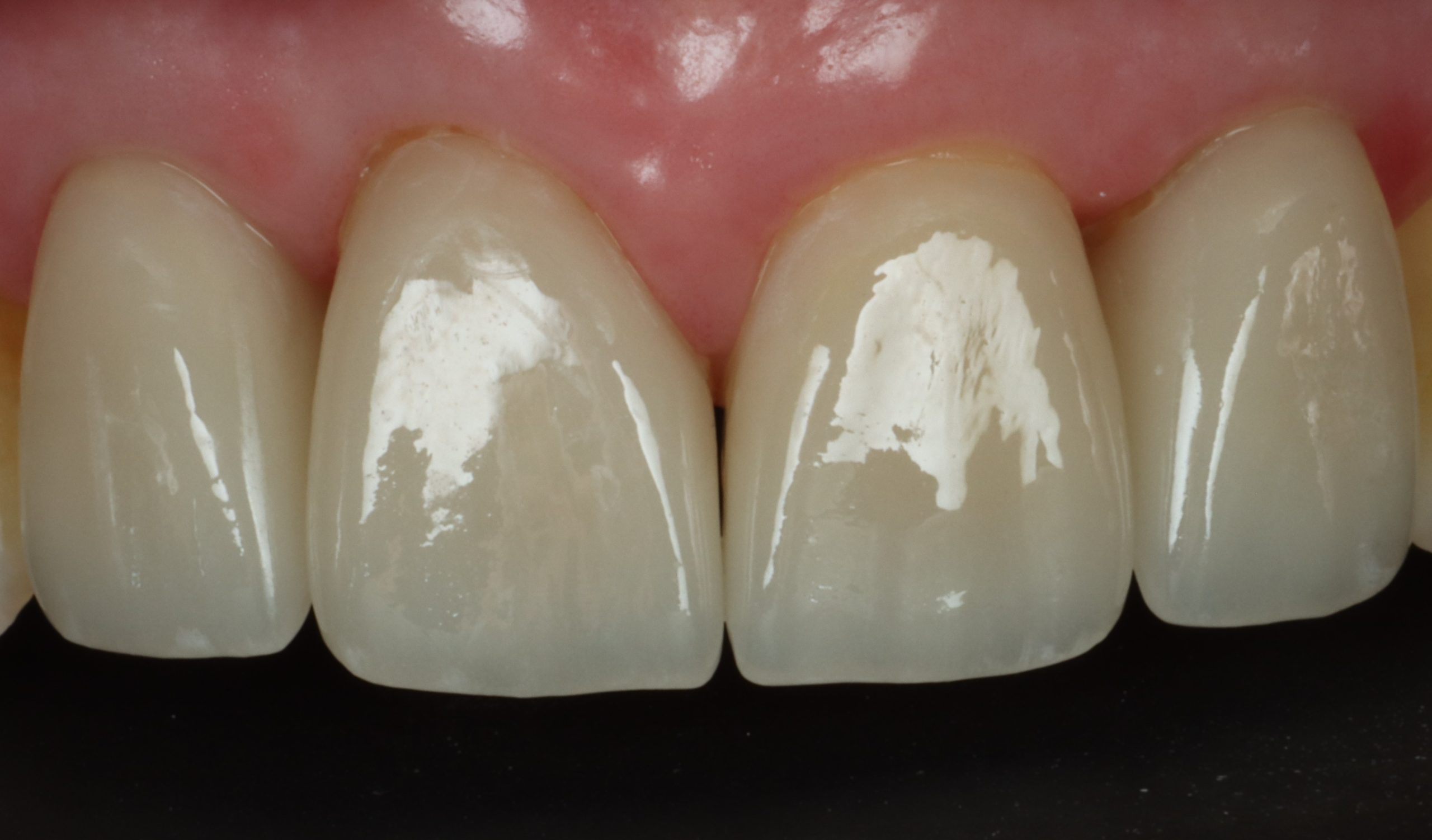 Elizabeth N after discolored teeth