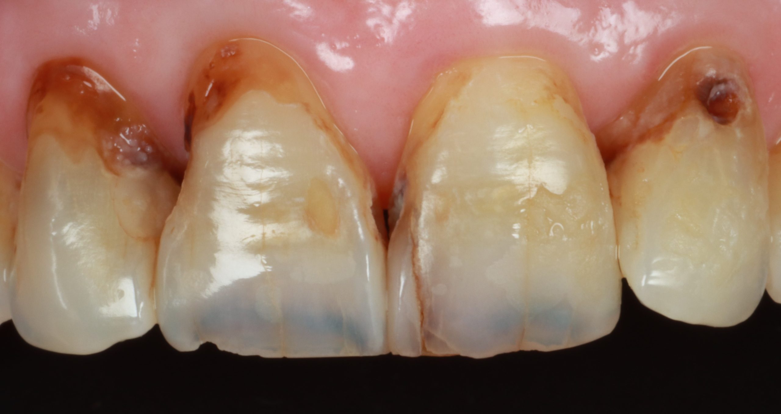 Elizabeth N before discolored teeth