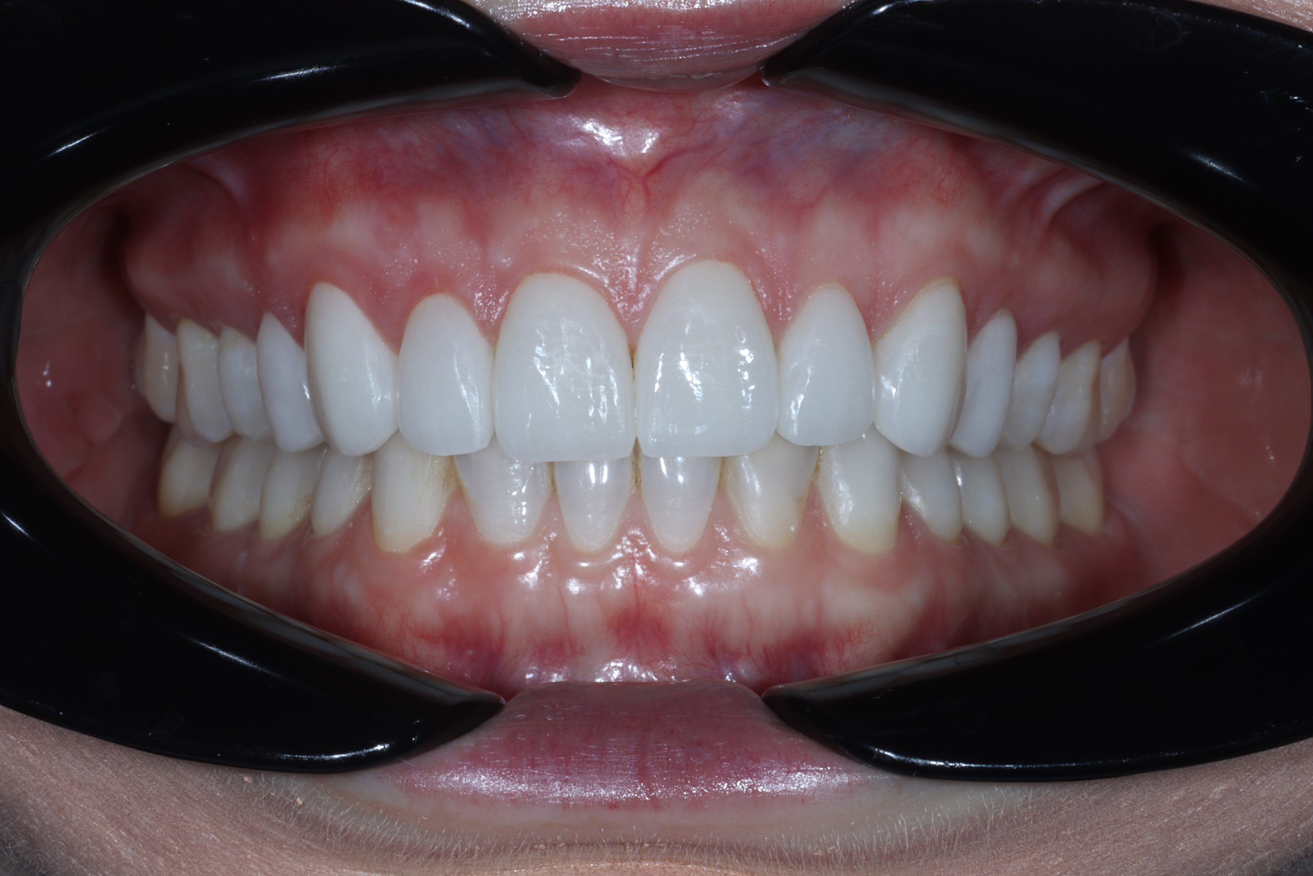 Erin R after dental veneers