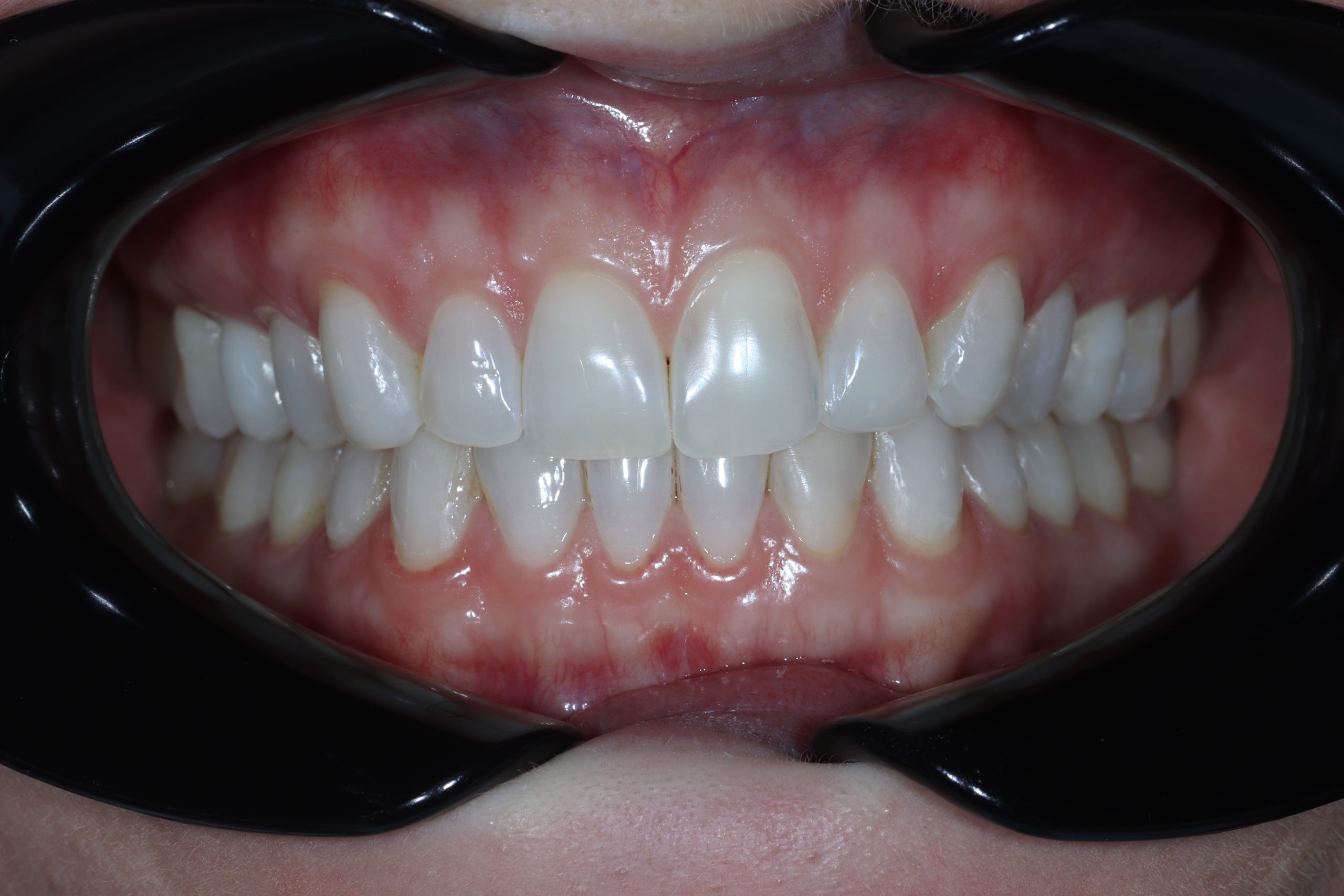 Erin R before dental veneers