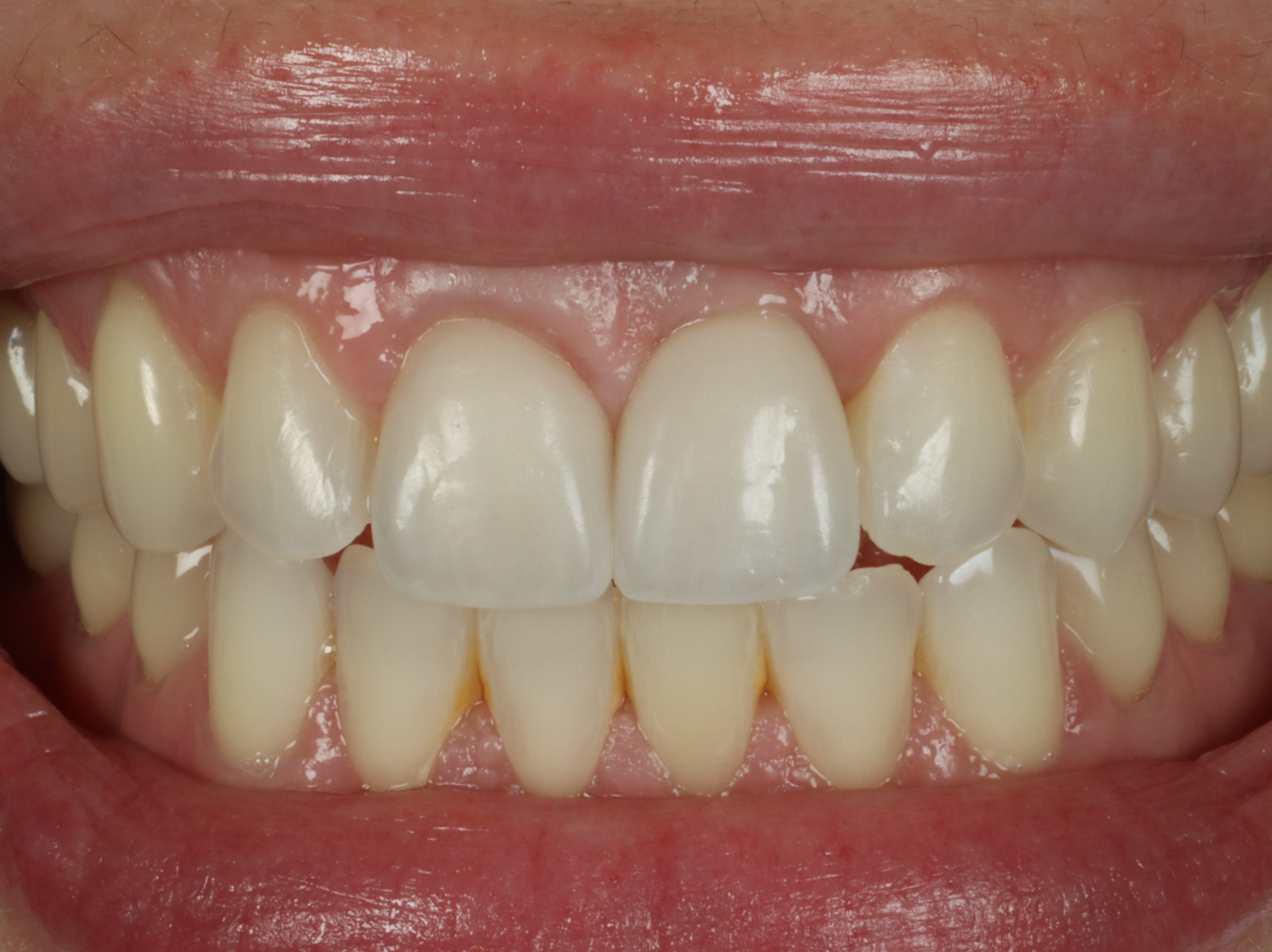 Harris after restored implants