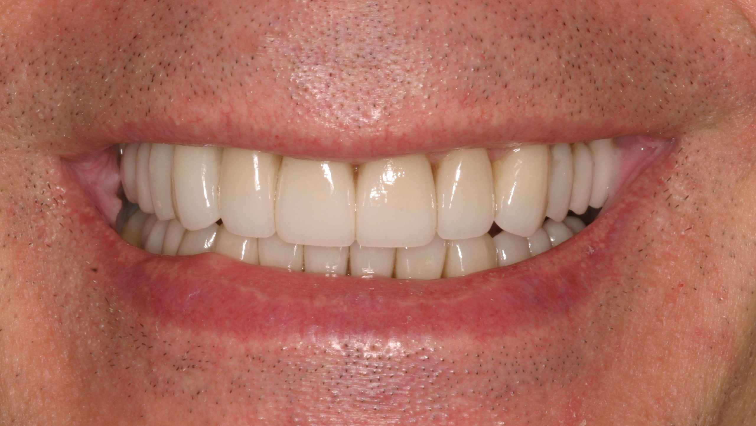 Frank V after smile rejuvenation