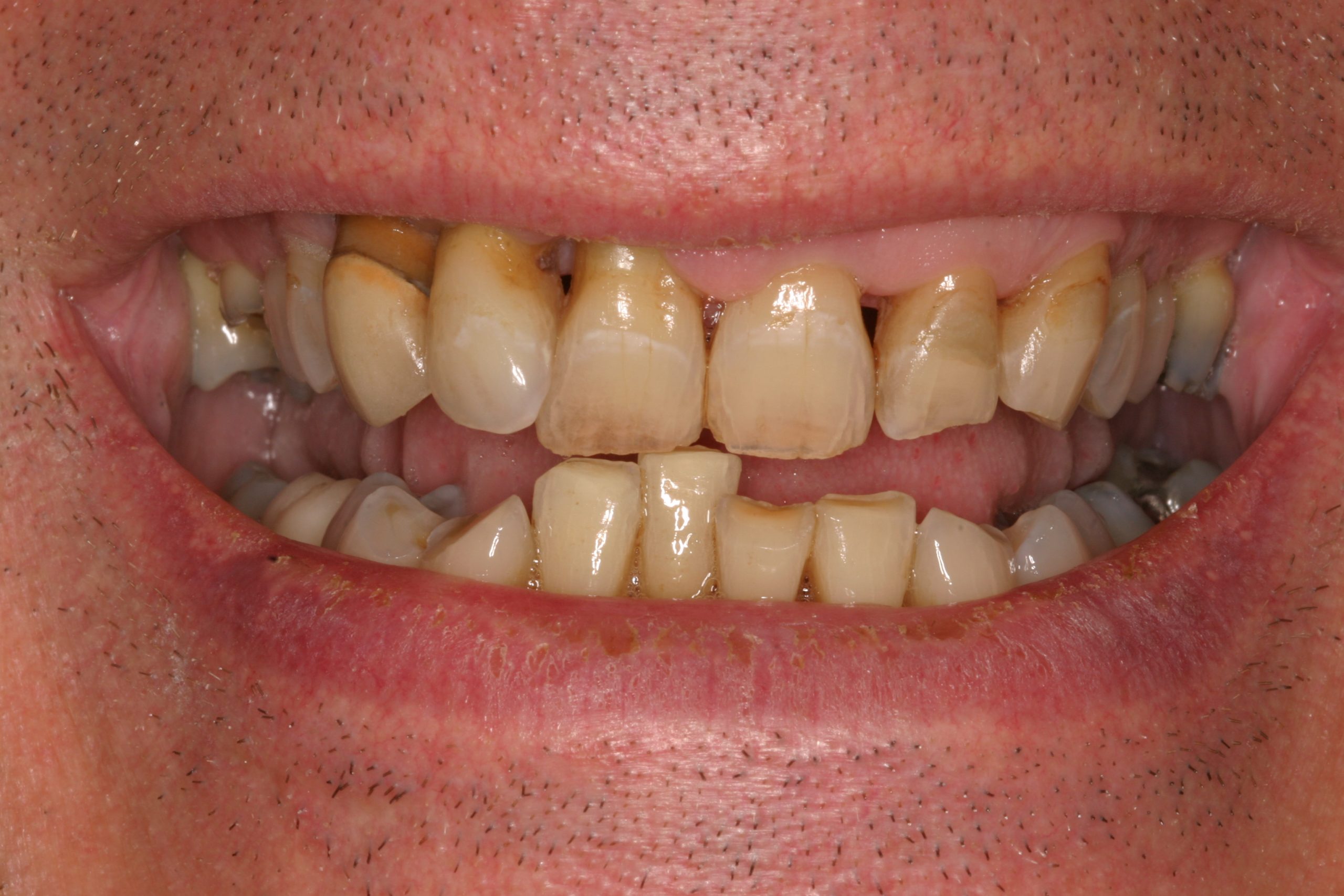 Frank V before smile rejuvenation