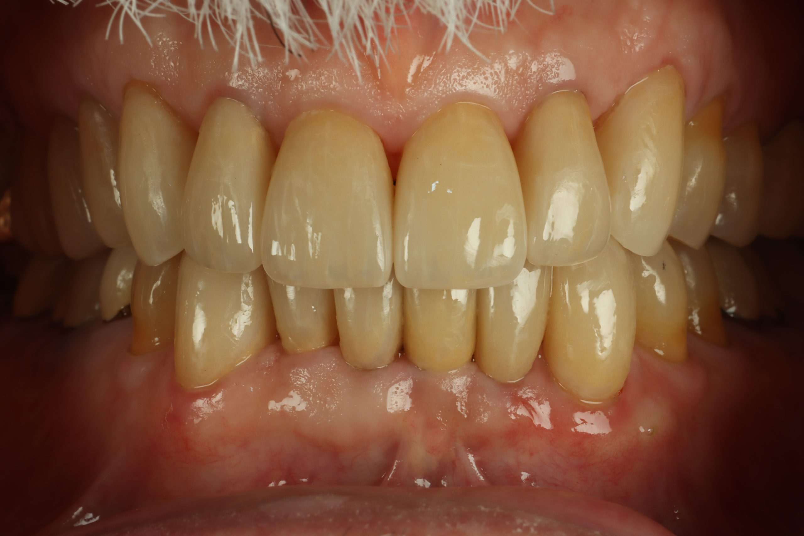 Gary L after dental veneers