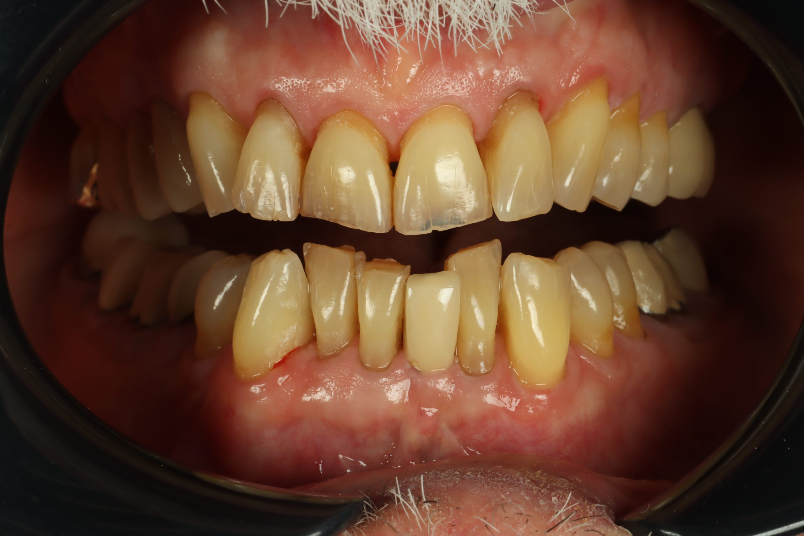 Gary L before dental veneers