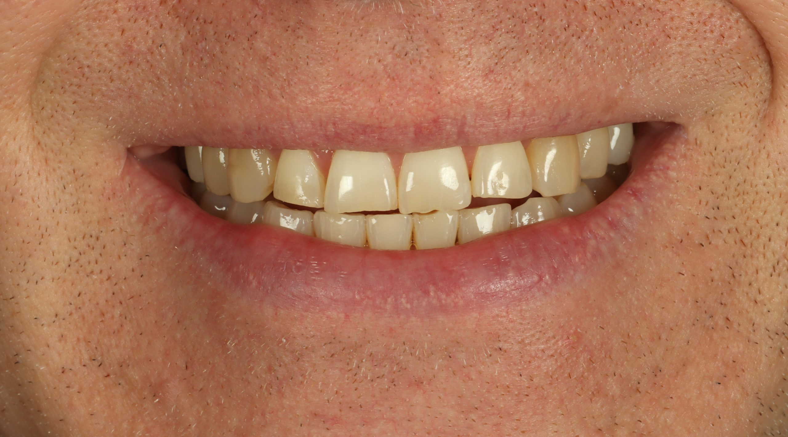 Greg N before worn teeth