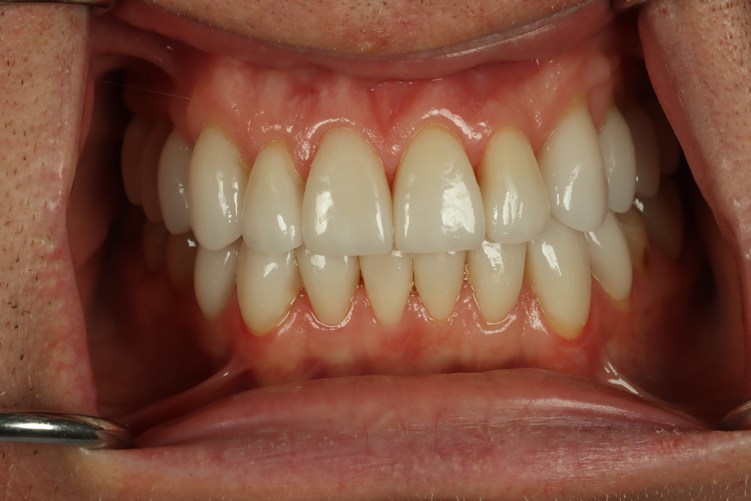 Greg N after worn teeth
