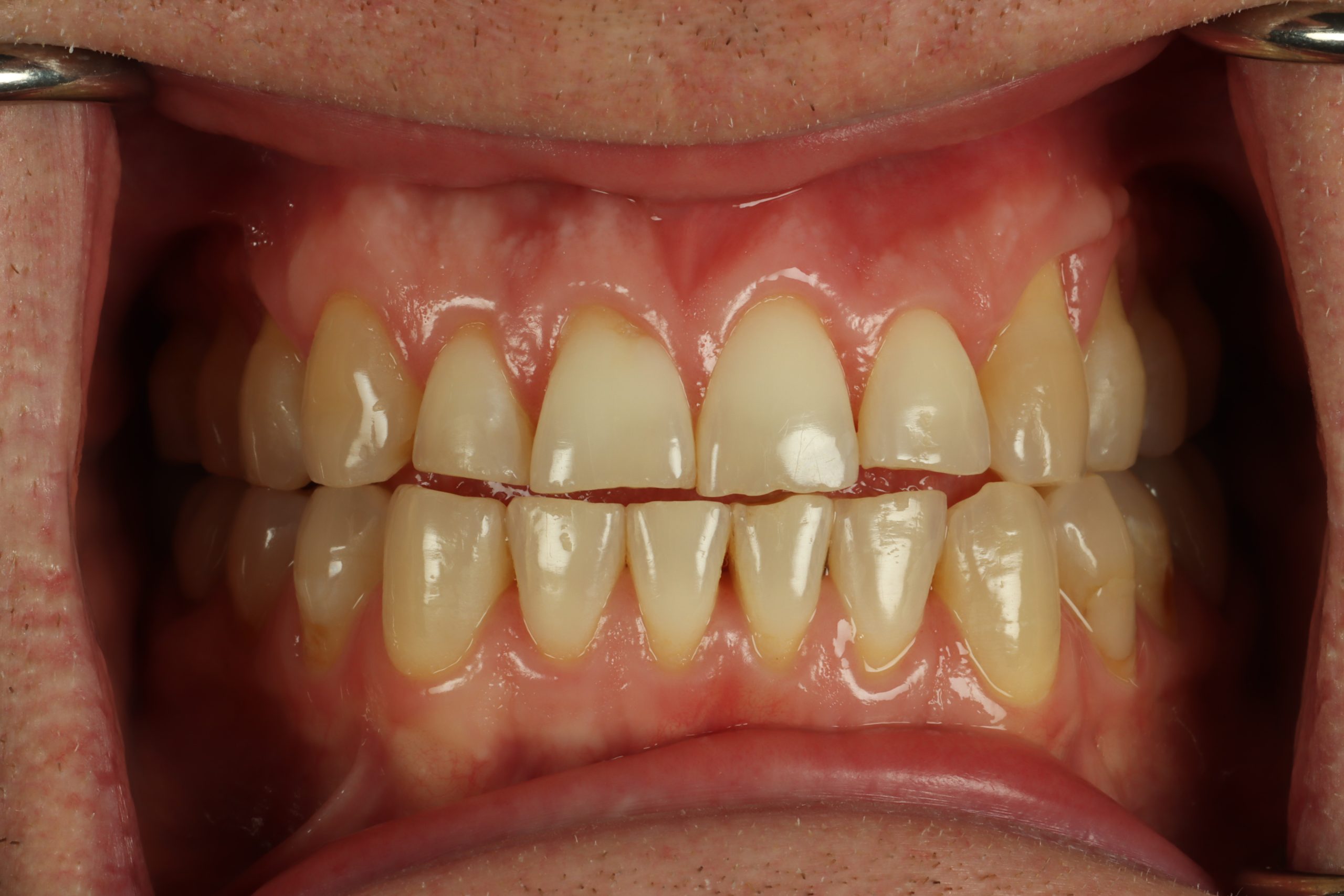 Greg N retracted before worn teeth
