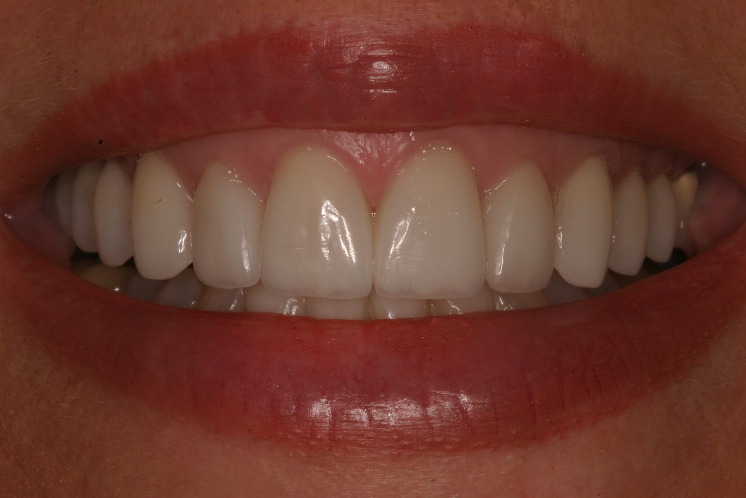 Gummy smile case after gummy smiles
