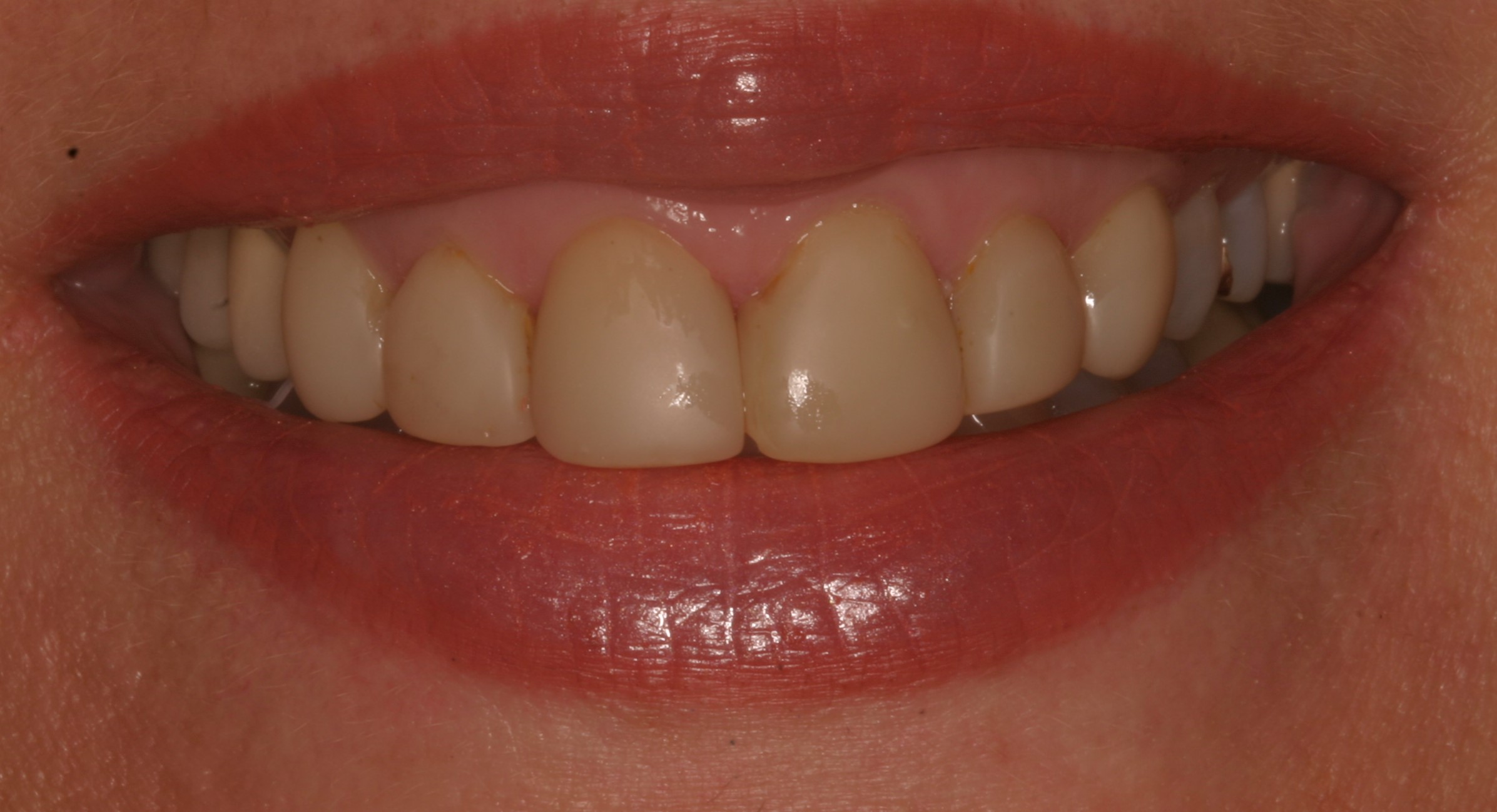 Gummy smile case before gummy smiles