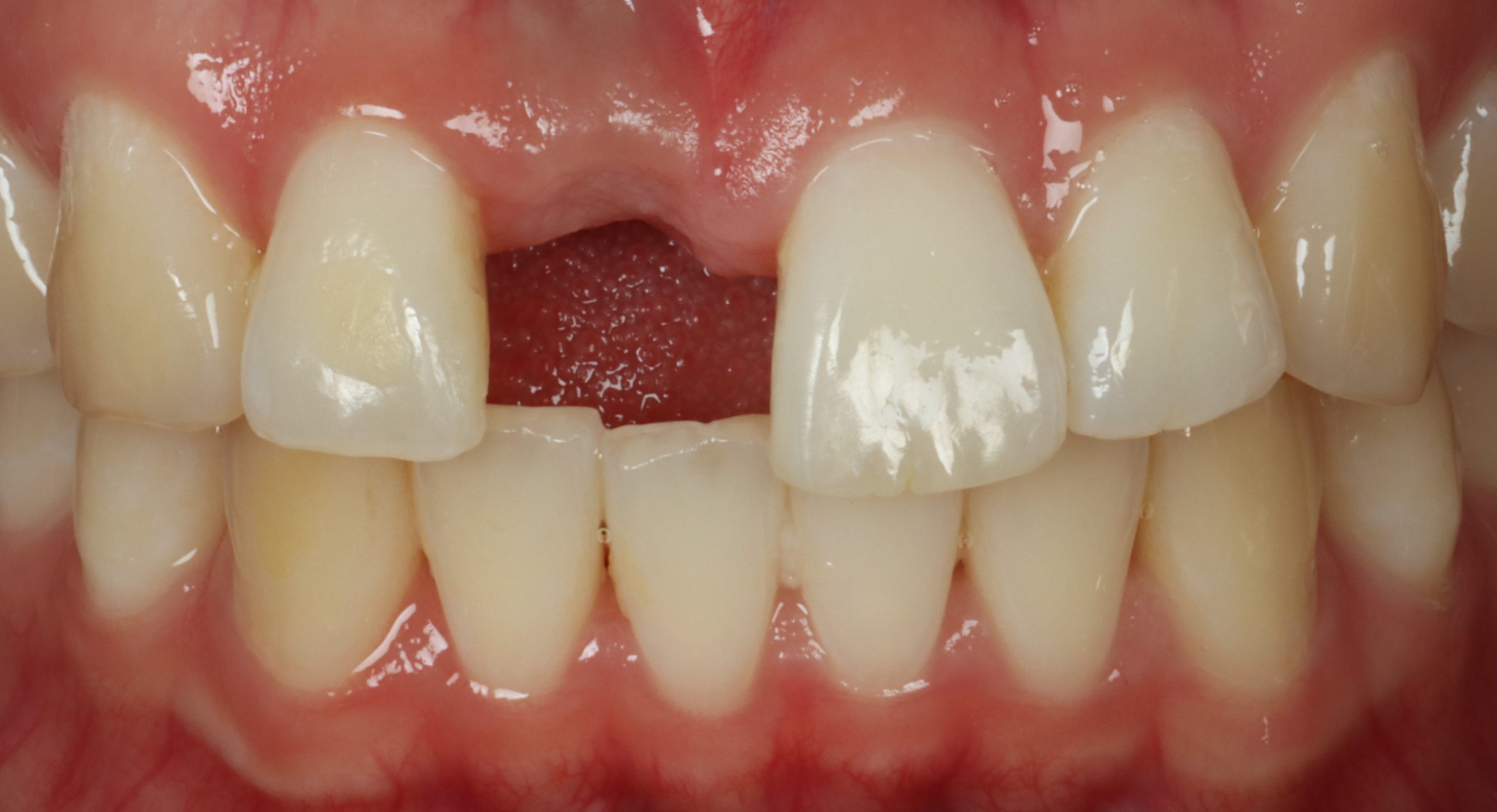 Harris before restored implants