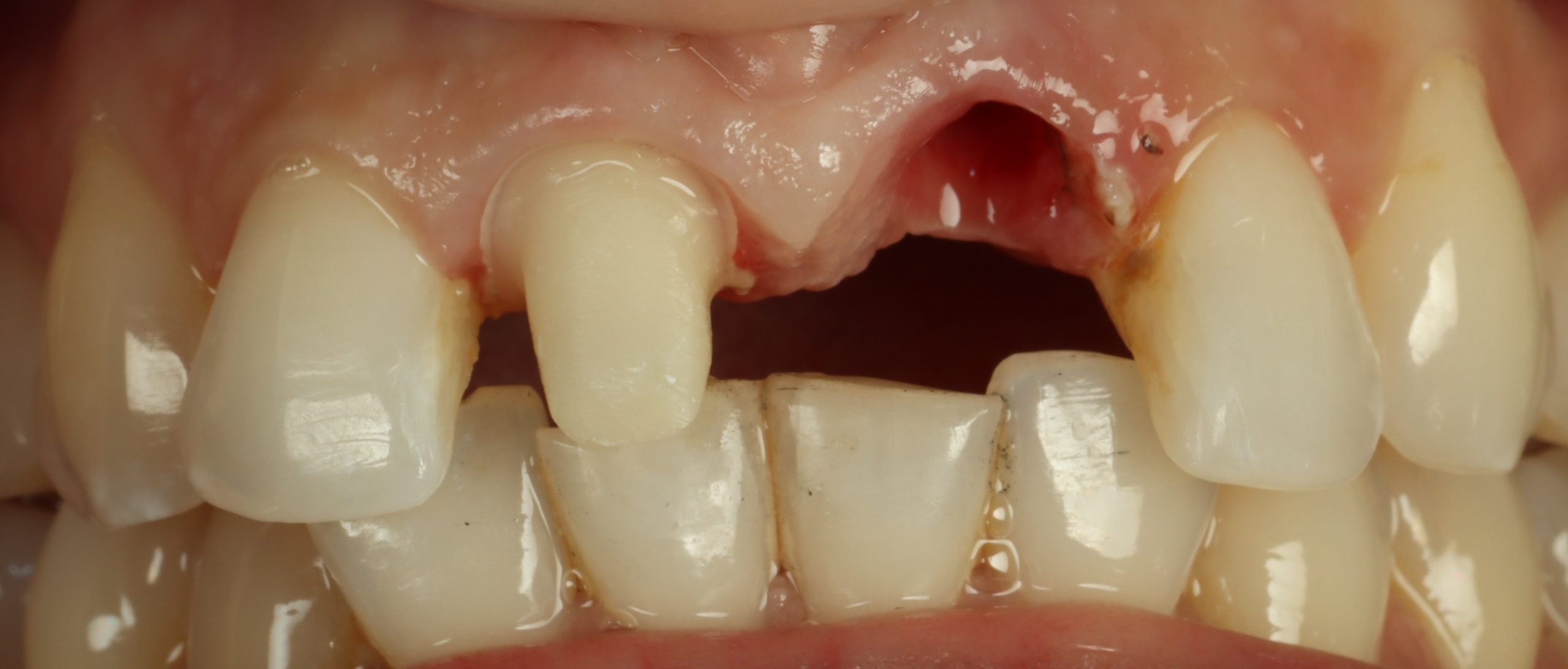 Hastie before restored implants