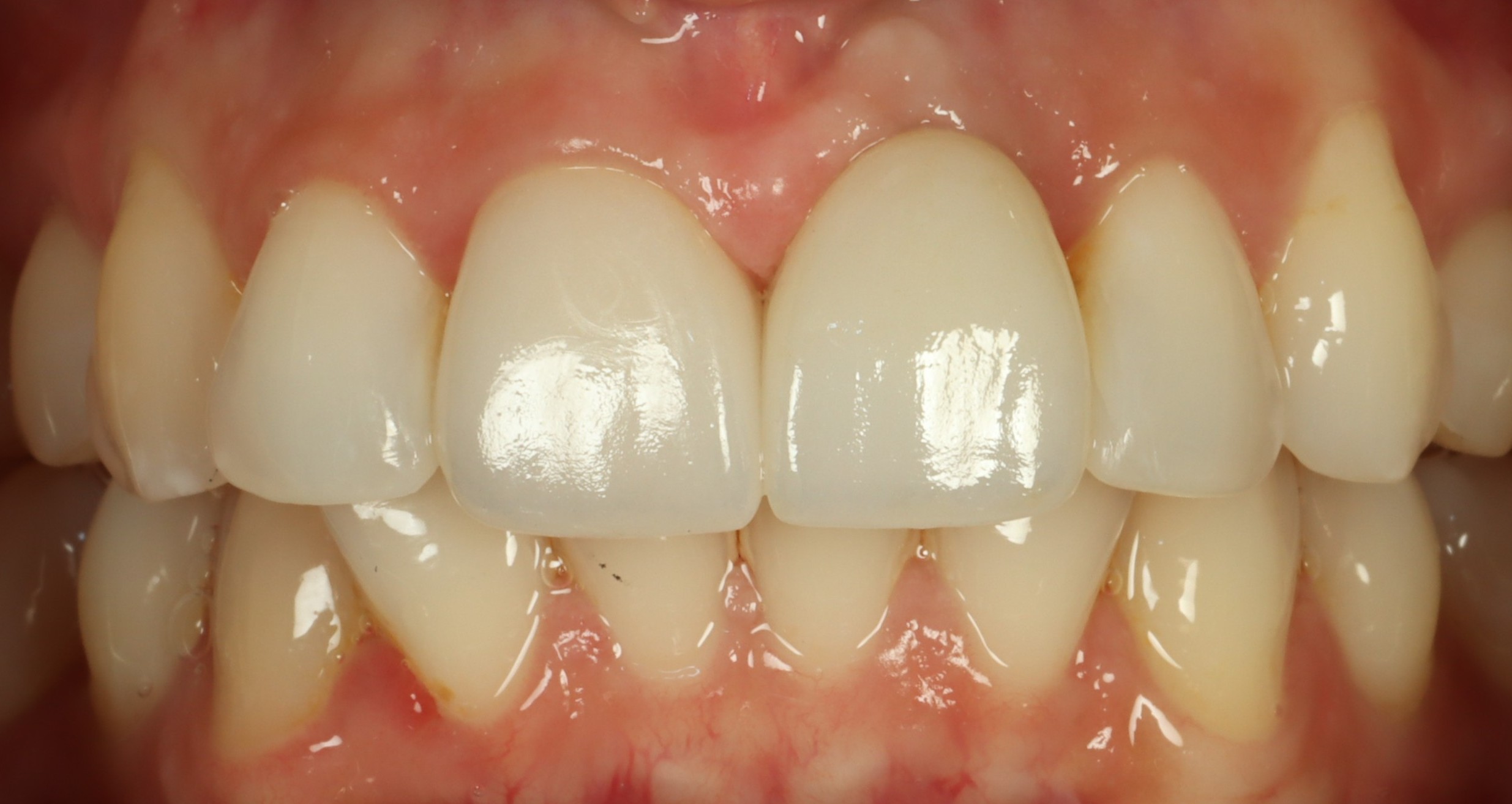 Hastie after restored implants