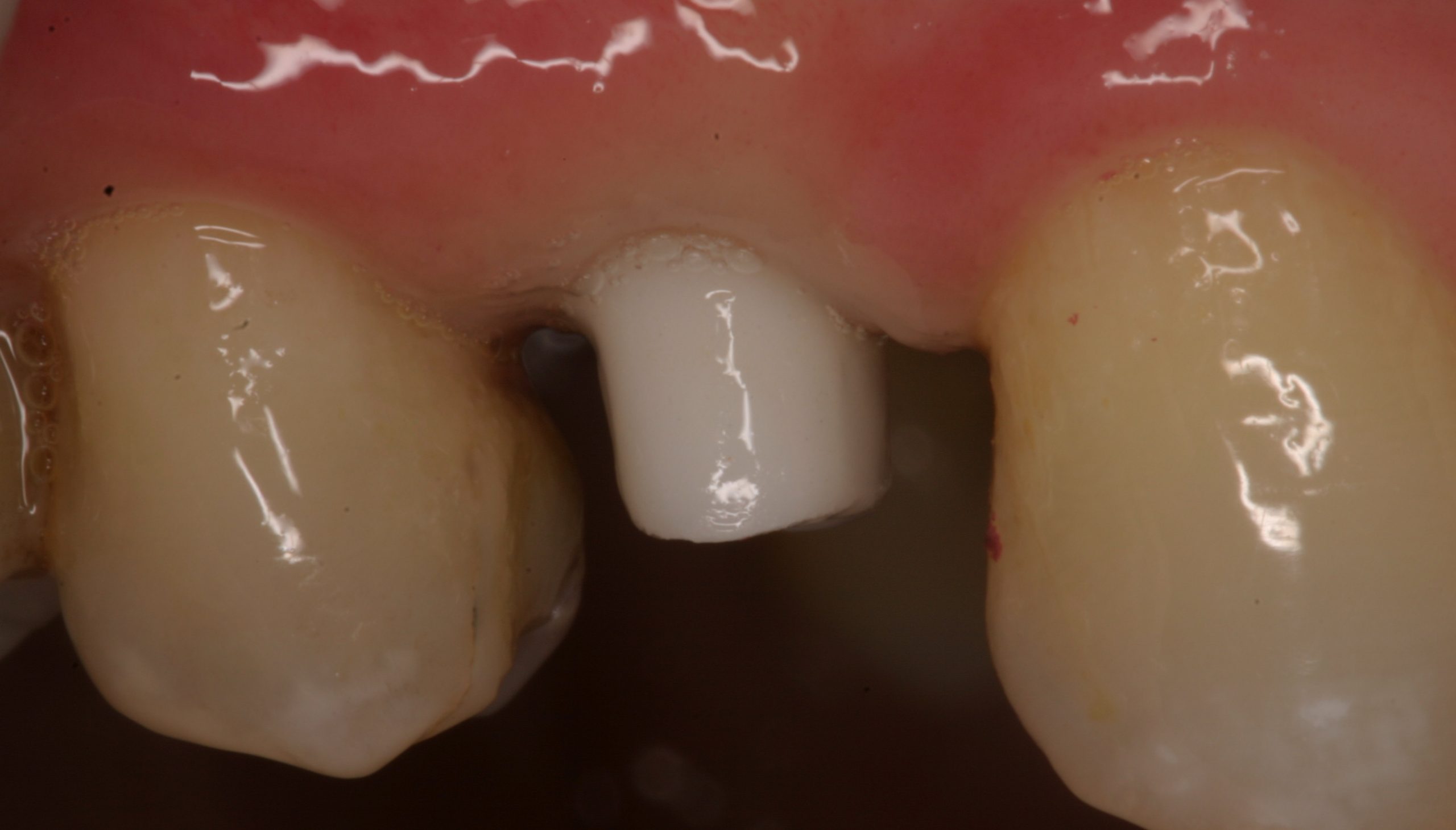 Implant crown before restored implants