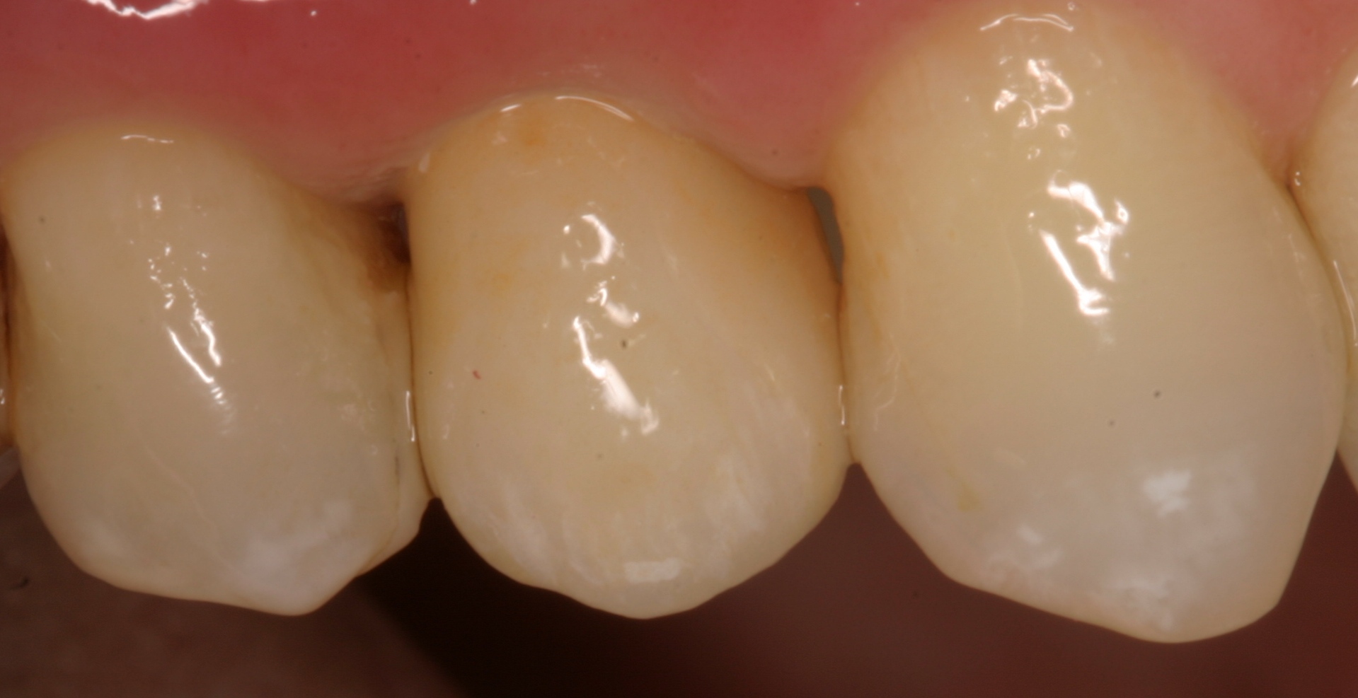 Implant crown after restored implants