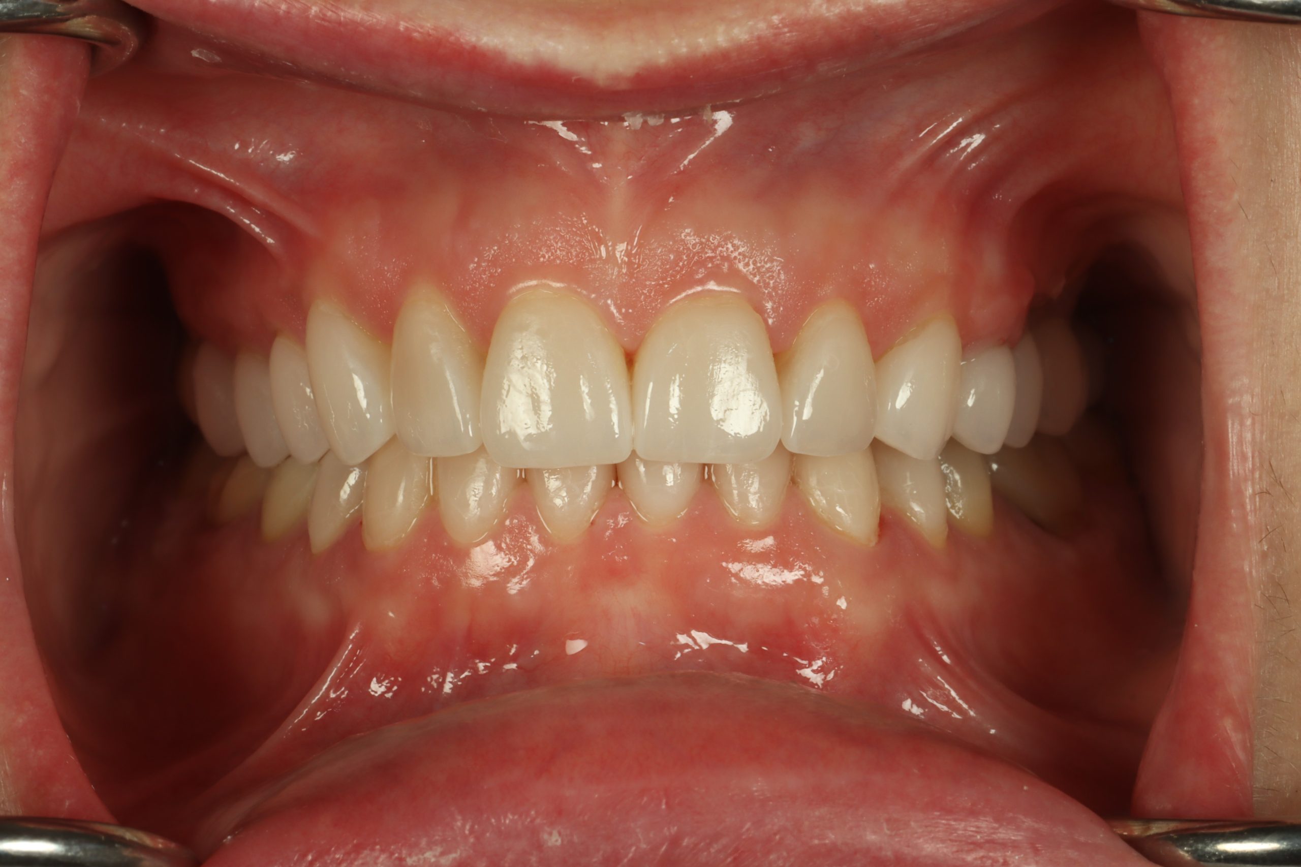 Jennifer F after worn teeth