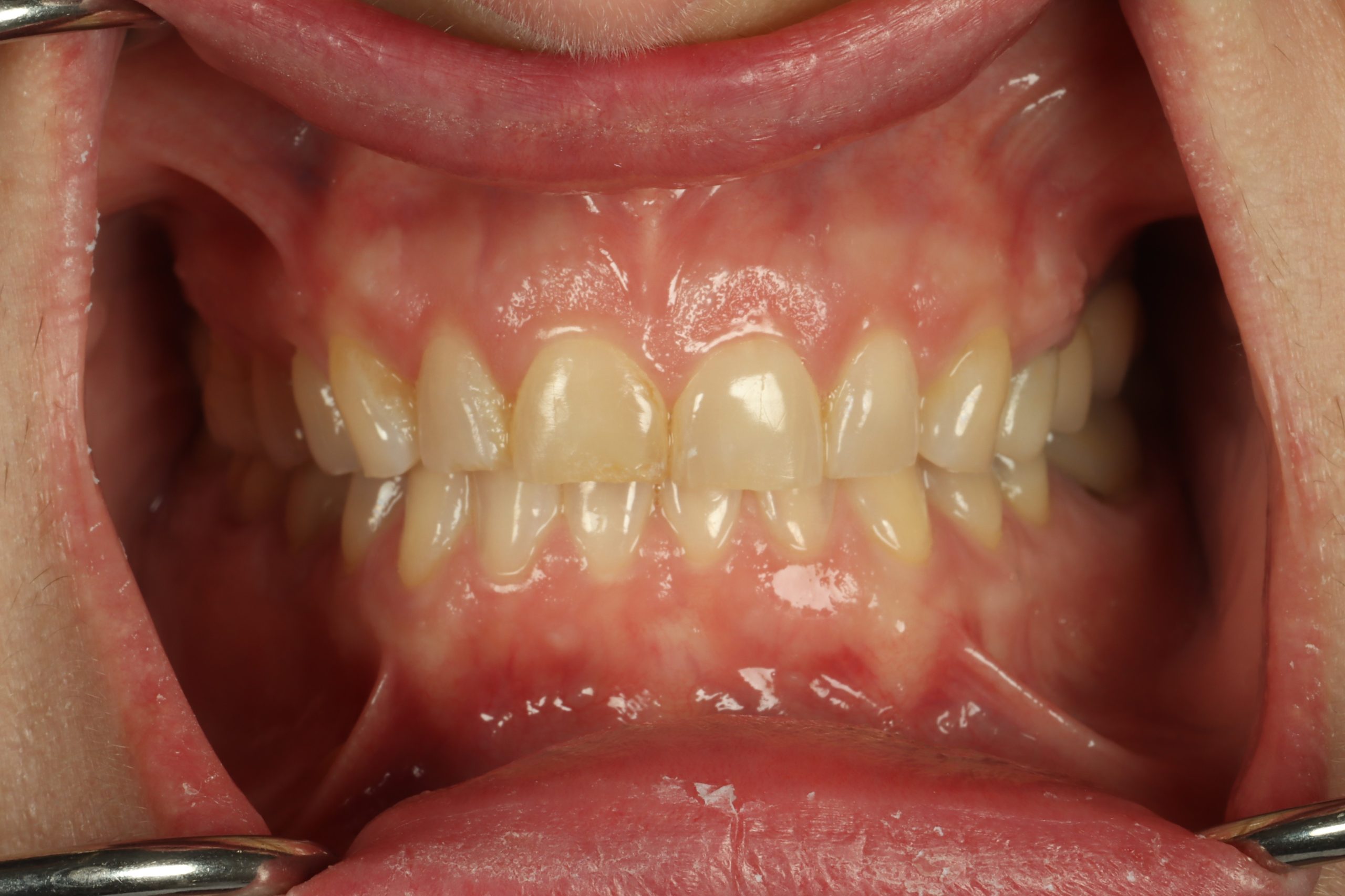 Jennifer F before worn teeth