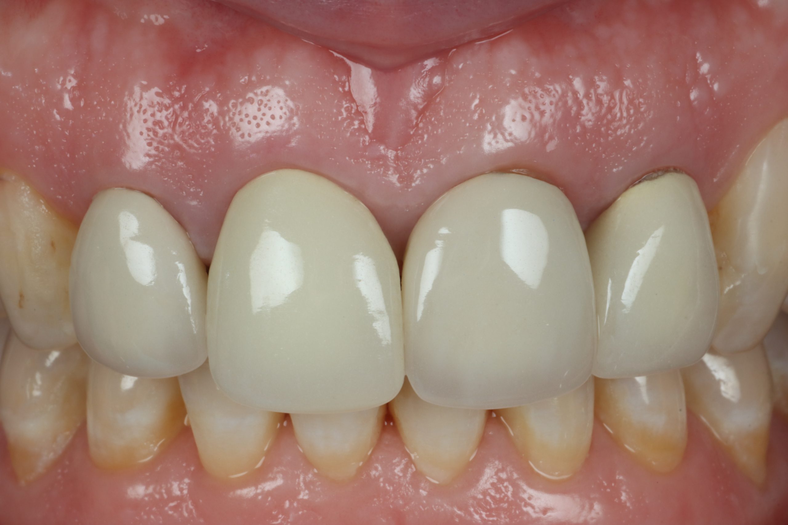 Jennifer V before smile rejuvenation