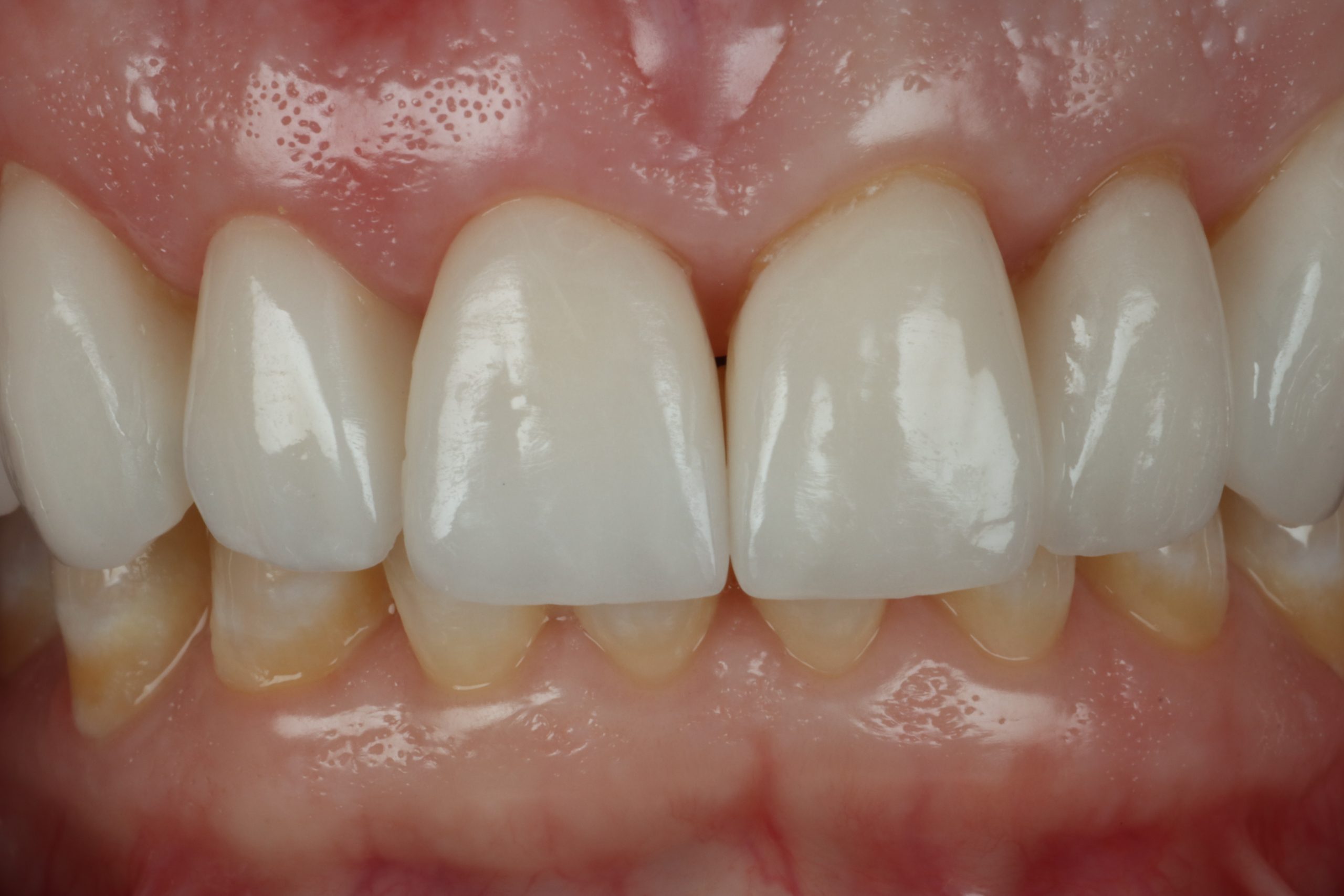 Jennifer V after smile rejuvenation
