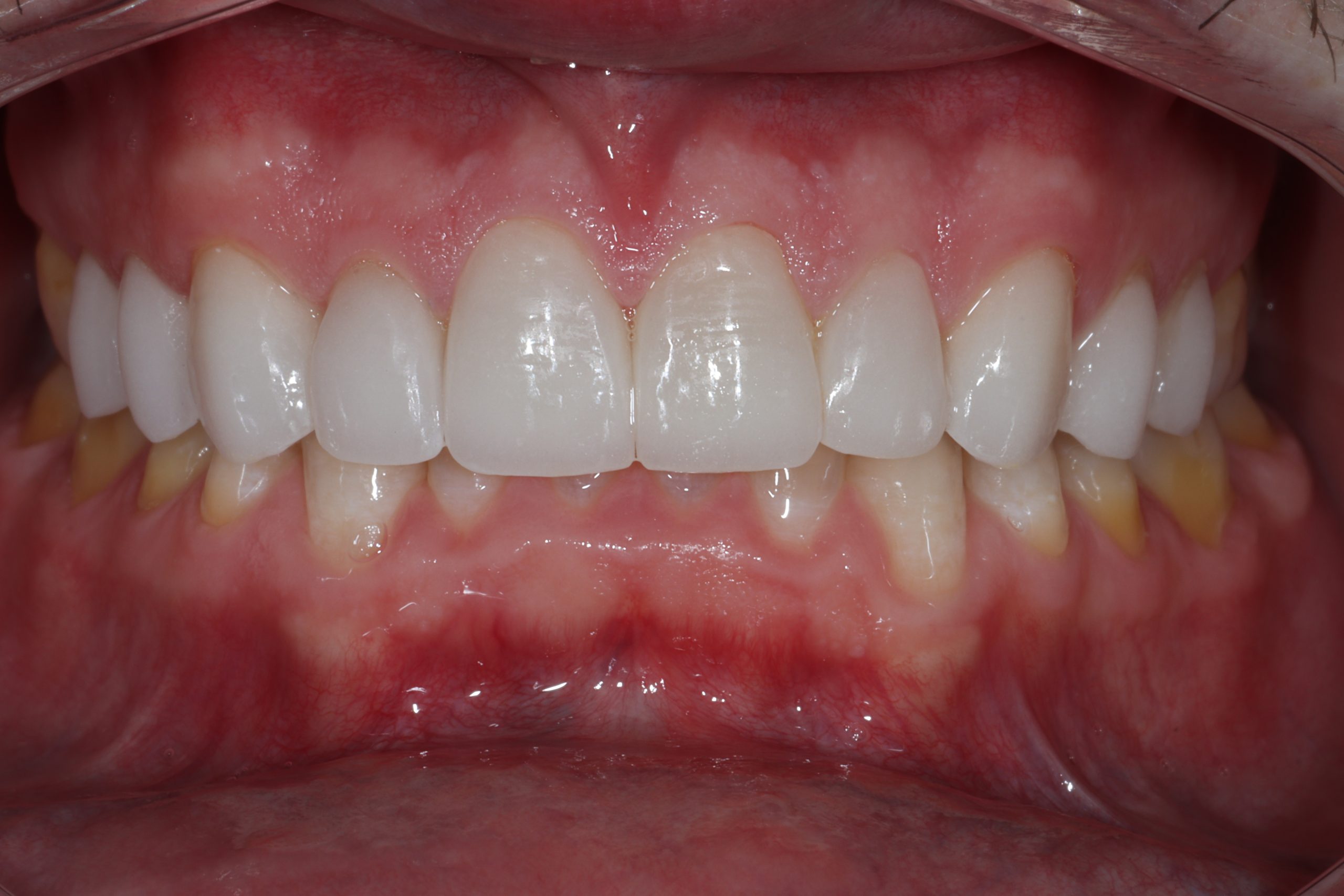 Kyle C after dental veneers